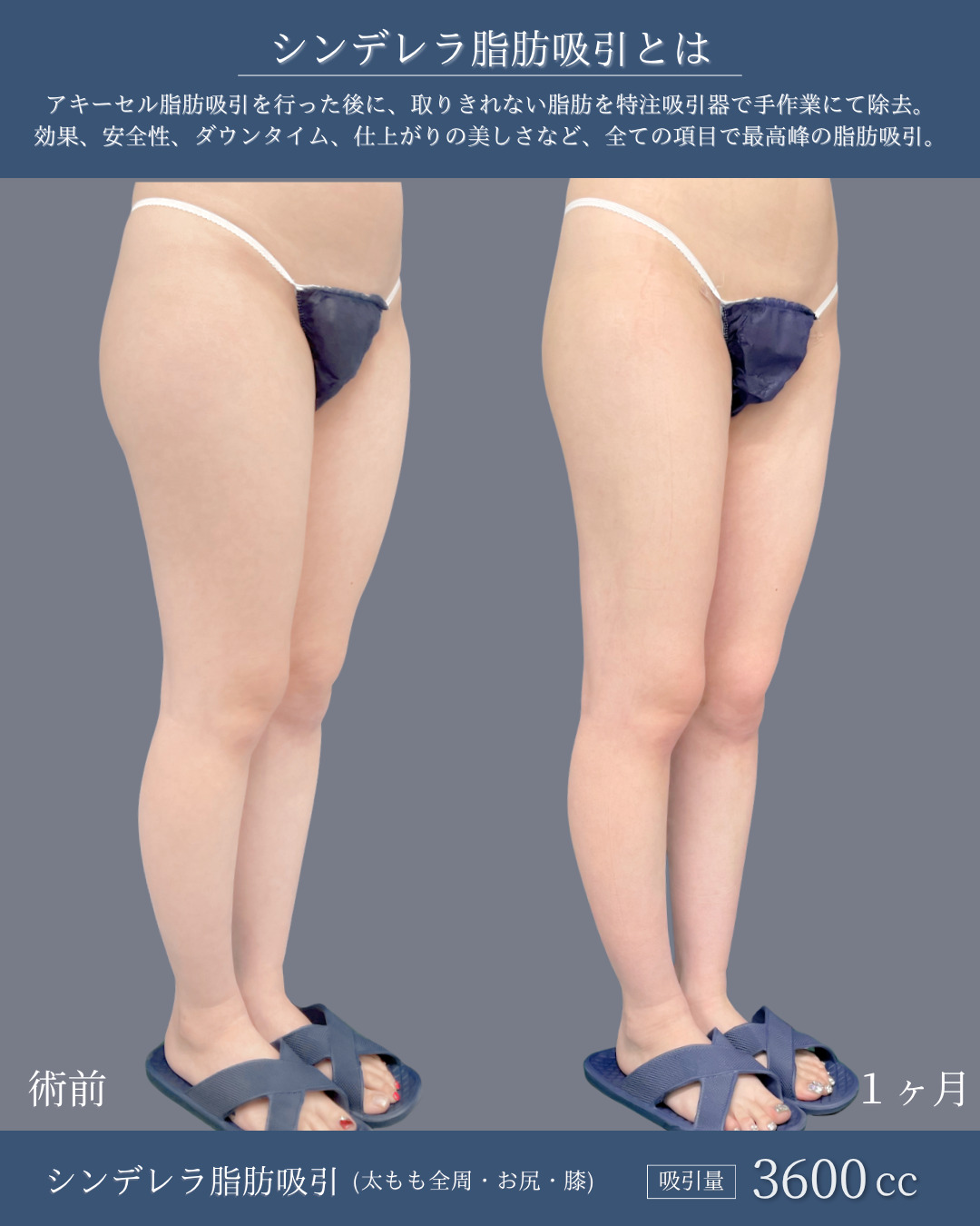 シンデレラ脂肪吸引で太ももの脂肪がなくなり隙間ができた方の１ヶ月症例