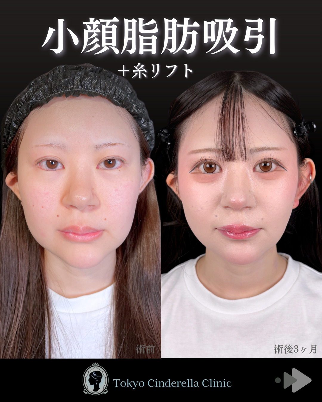 池袋院で行った小顔脂肪吸引(頬) とシークレットリフト12本整形で有名な名医の石井達也の症例写真