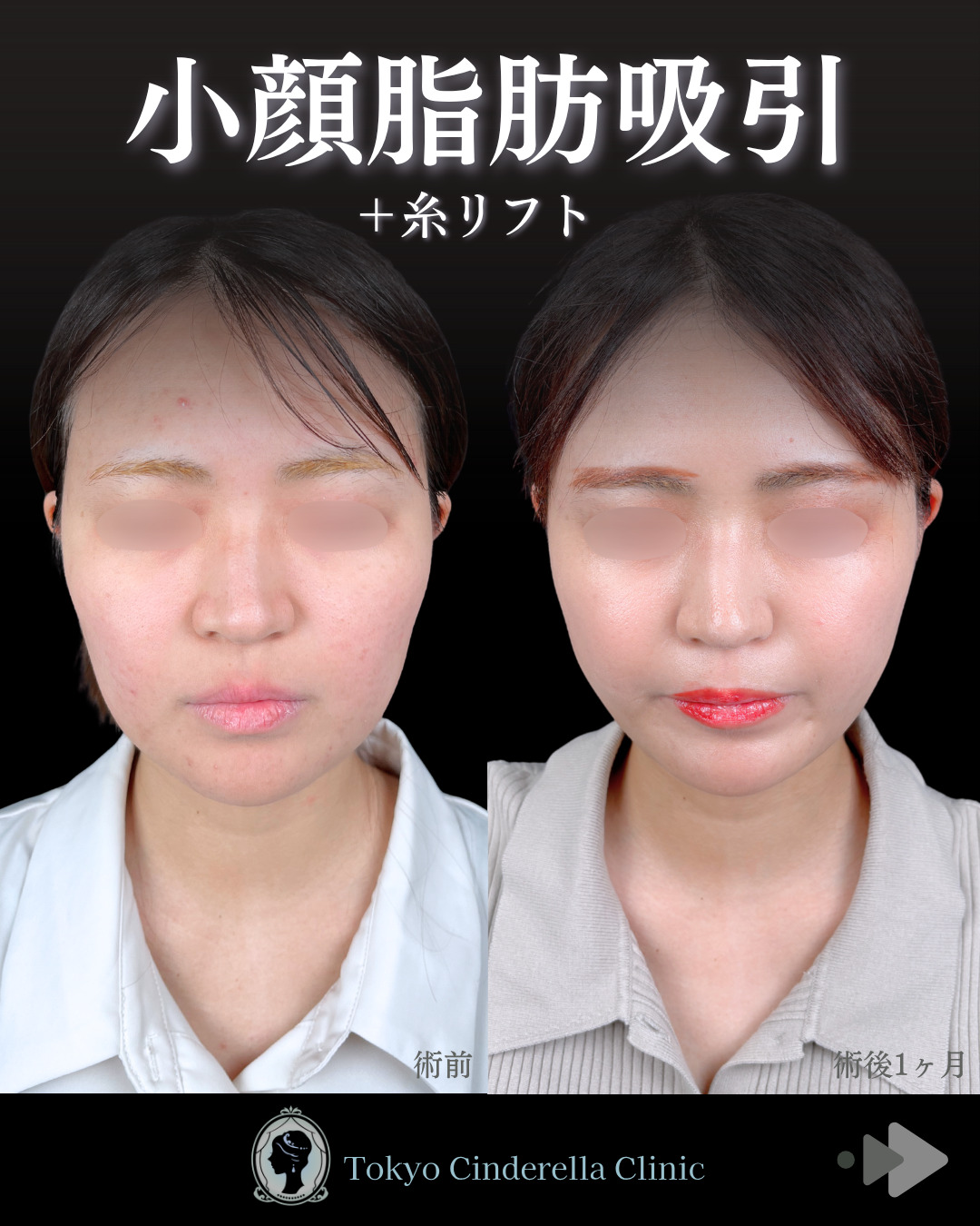 池袋院で行った小顔整形の名医の症例写真