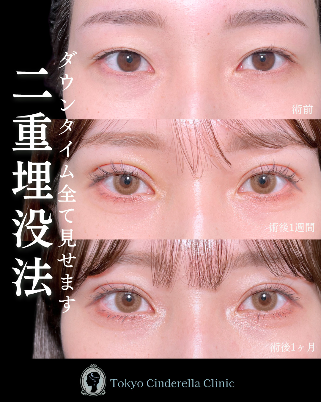 池袋院で行った二重埋没法整形で有名な名医の石井達也の症例写真