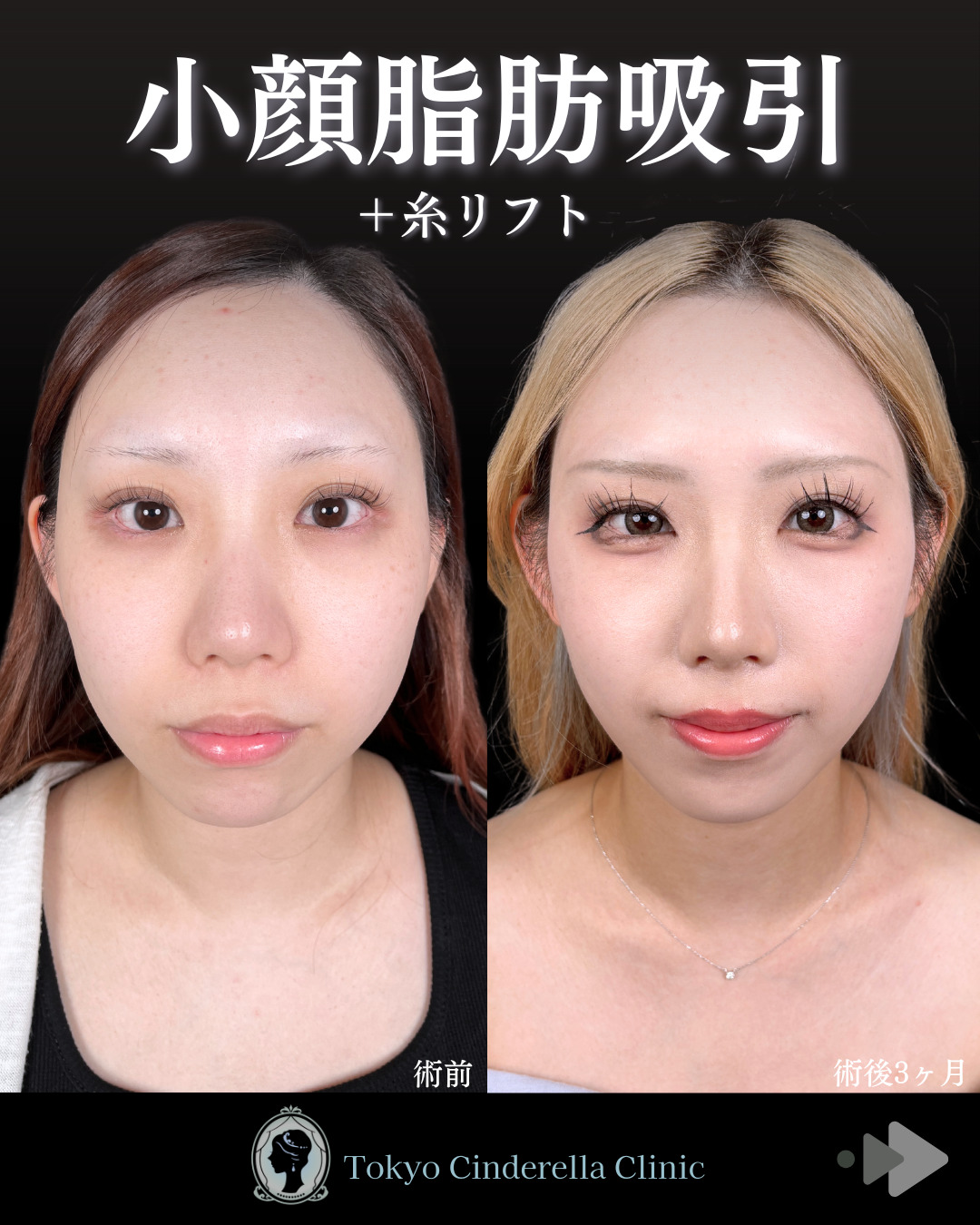 池袋院で行ったアキーセル小顔脂肪吸引(頬・あご下・エラ下・ジョールファット) とシークレットリフト12本整形で有名な名医の石井達也の症例写真