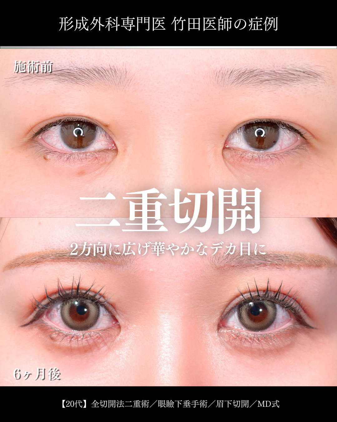 大宮院で行った二重整形で有名な竹田昌平医師の全切開二重術と眼瞼下垂手術と眉下切開と目頭切開の症例写真