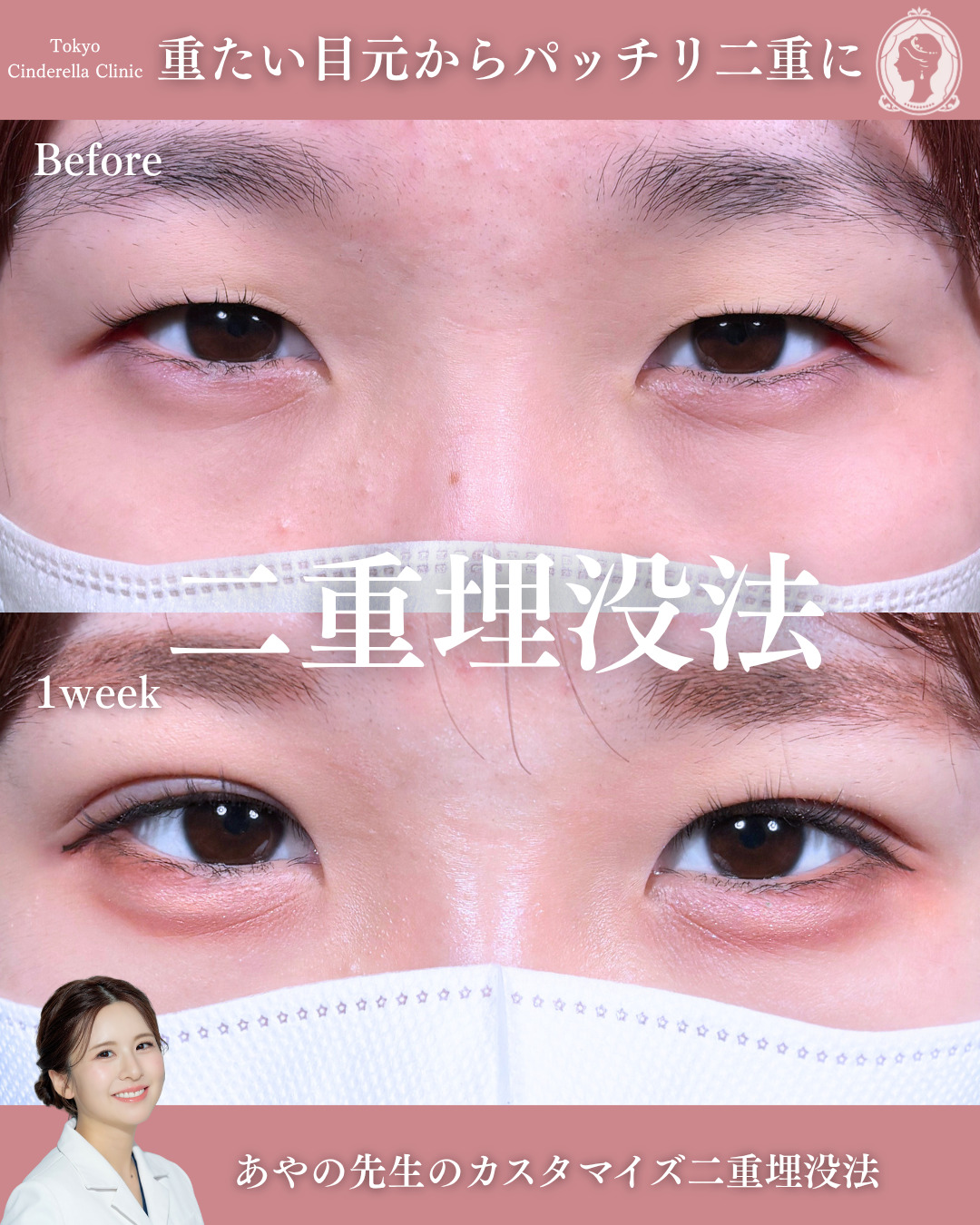 新宿院で行った二重埋没法の名医の梅田彩乃医師の症例写真