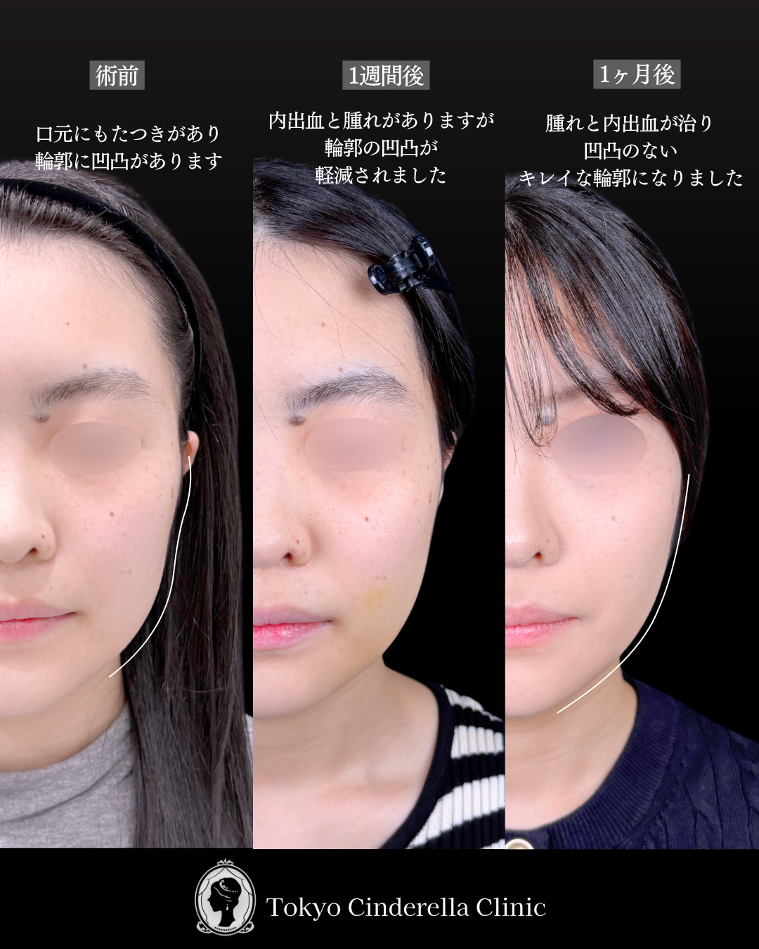 池袋院で行ったアキーセル小顔脂肪吸引(頬・あご下・エラ下・ジョールファット) と糸リフト8本整形の名医の症例写真