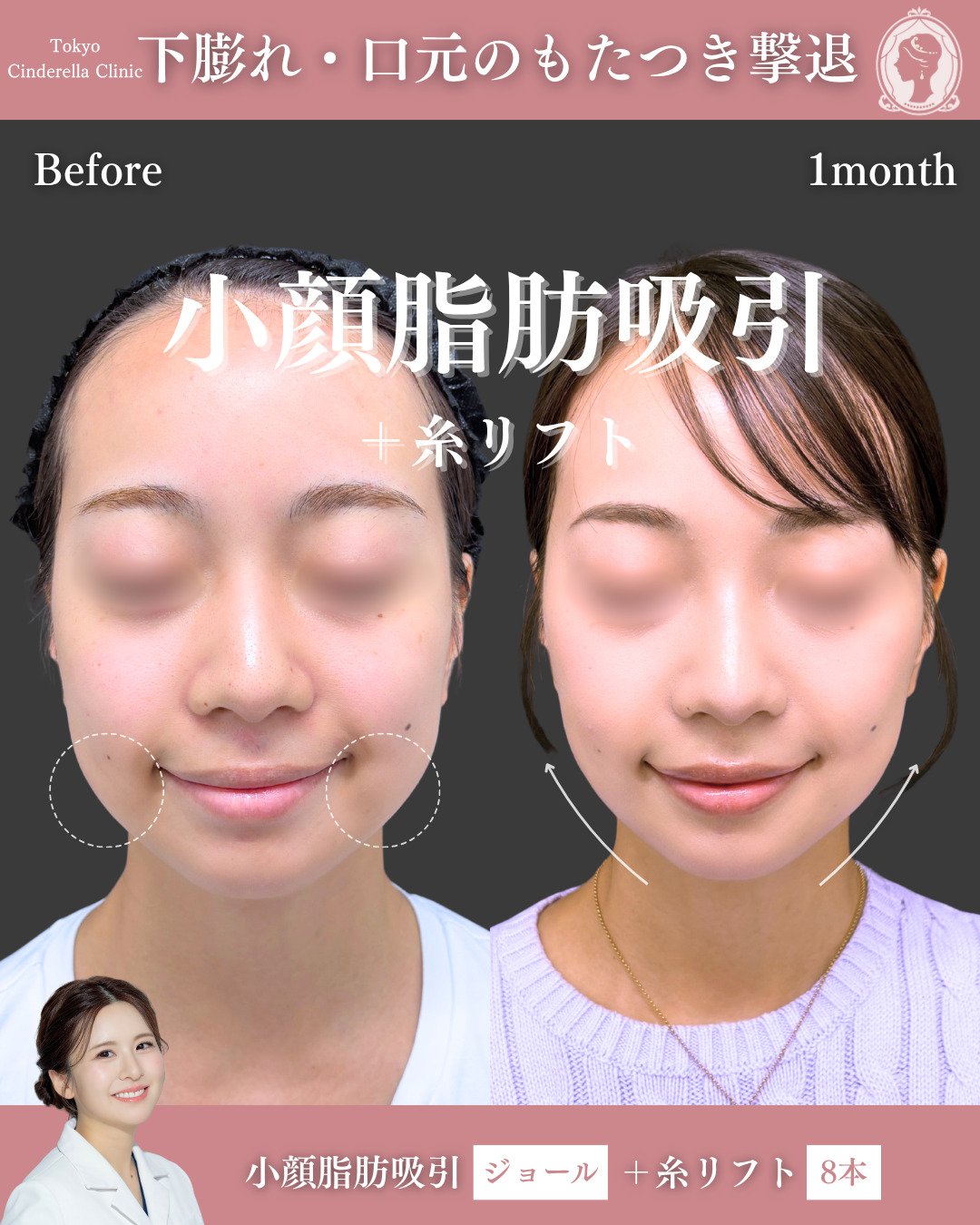 新宿院で行った脂肪吸引の名医の梅田絢乃医師の症例写真