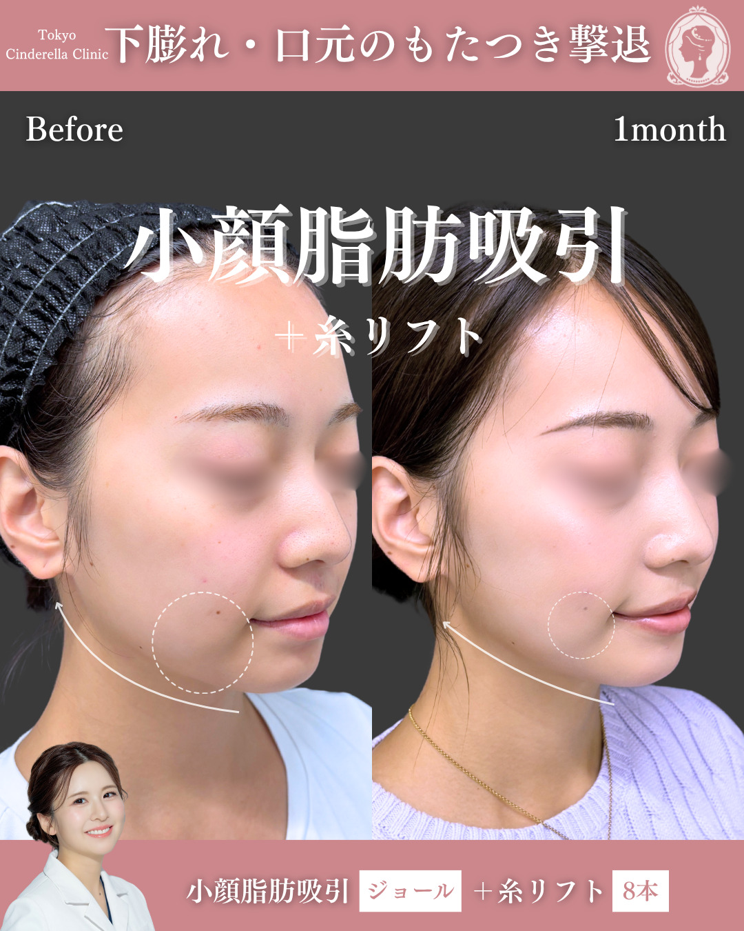 新宿院で行った脂肪吸引の名医の梅田絢乃医師の症例写真