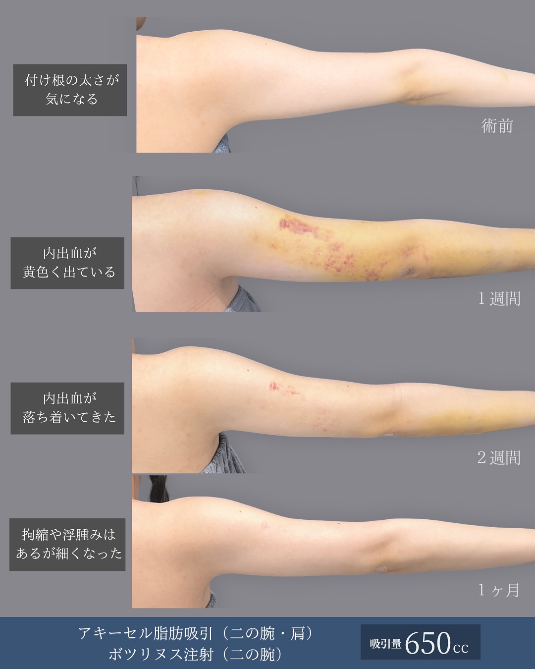 新宿院で行った二の腕のアキーセル脂肪吸引とボトックス注射併用の1ヶ月後までの症例写真