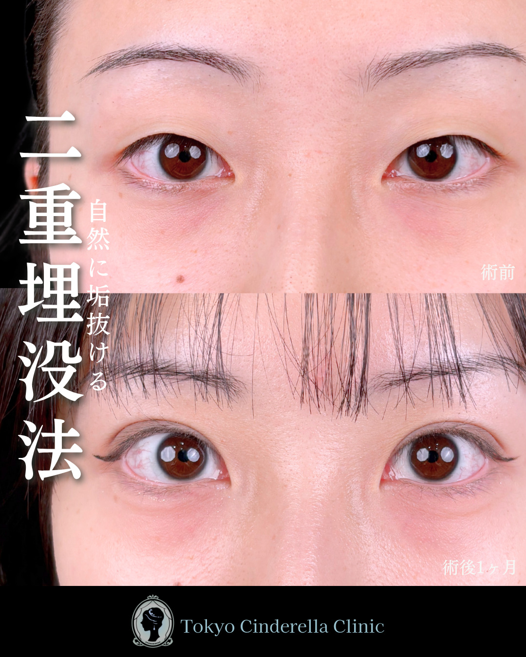 池袋院で行った二重整形で有名な名医の石井達也の症例写真