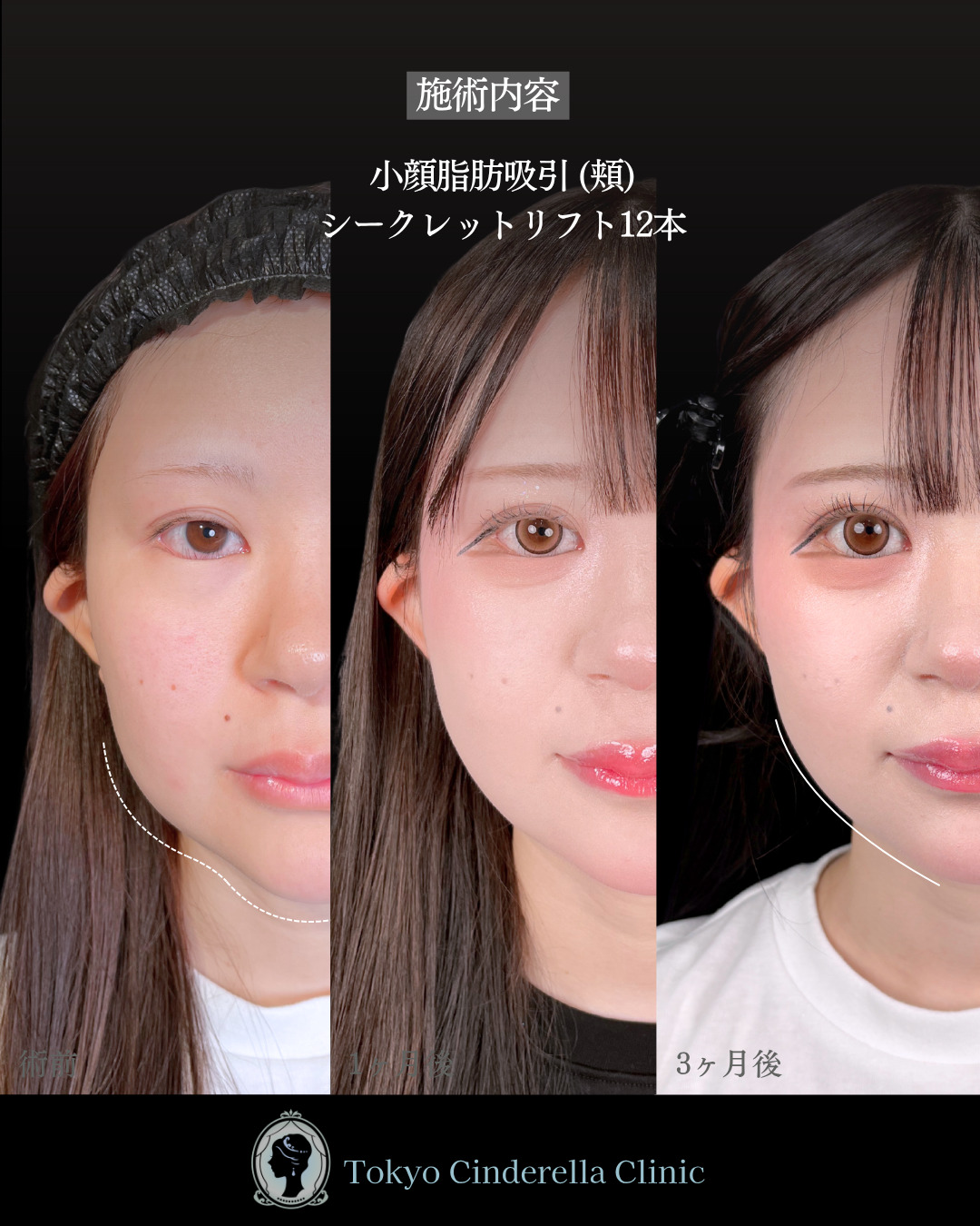 池袋院で行った小顔脂肪吸引(頬) とシークレットリフト12本整形で有名な名医の石井達也の症例写真