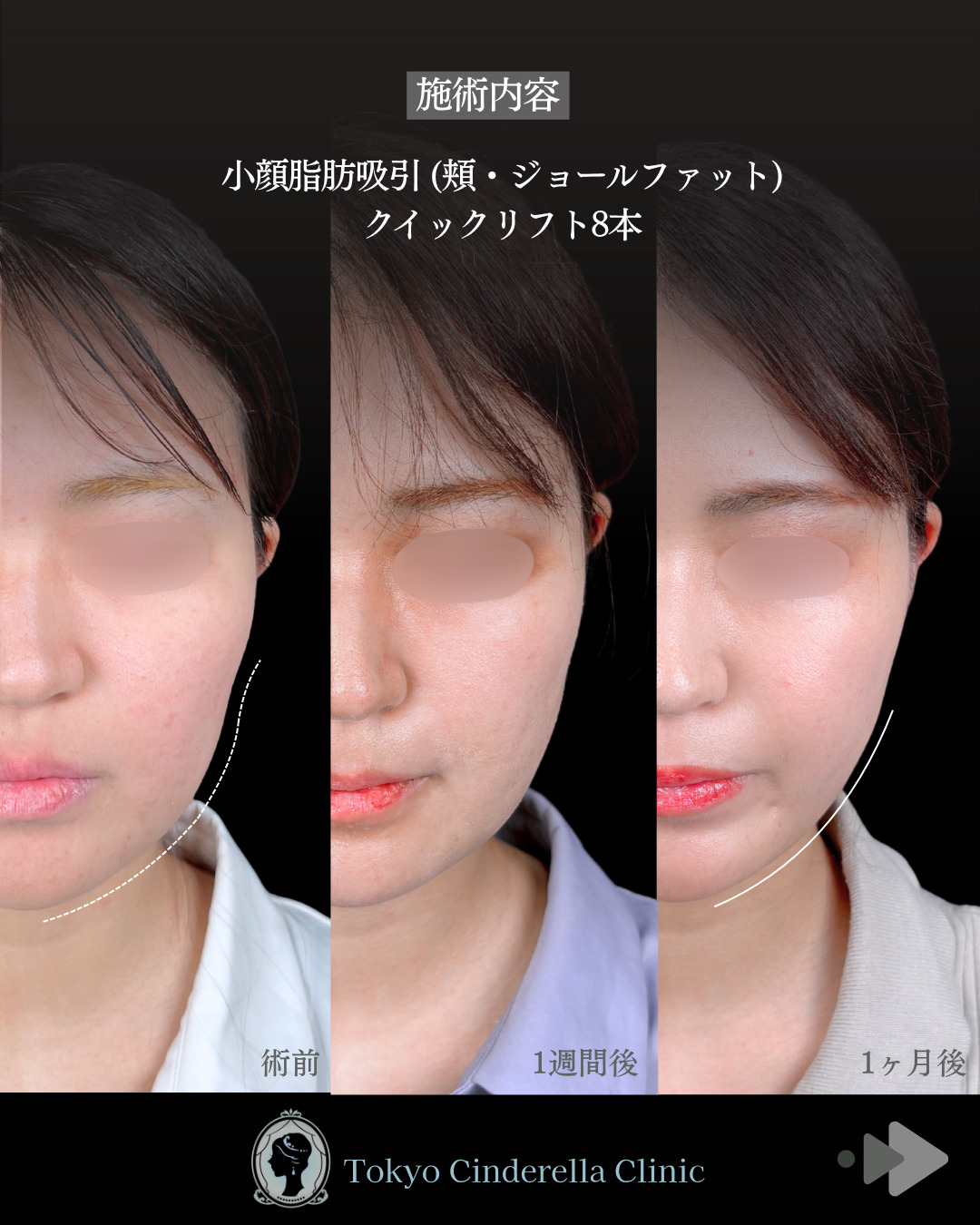 池袋院で行った小顔整形の名医の症例写真