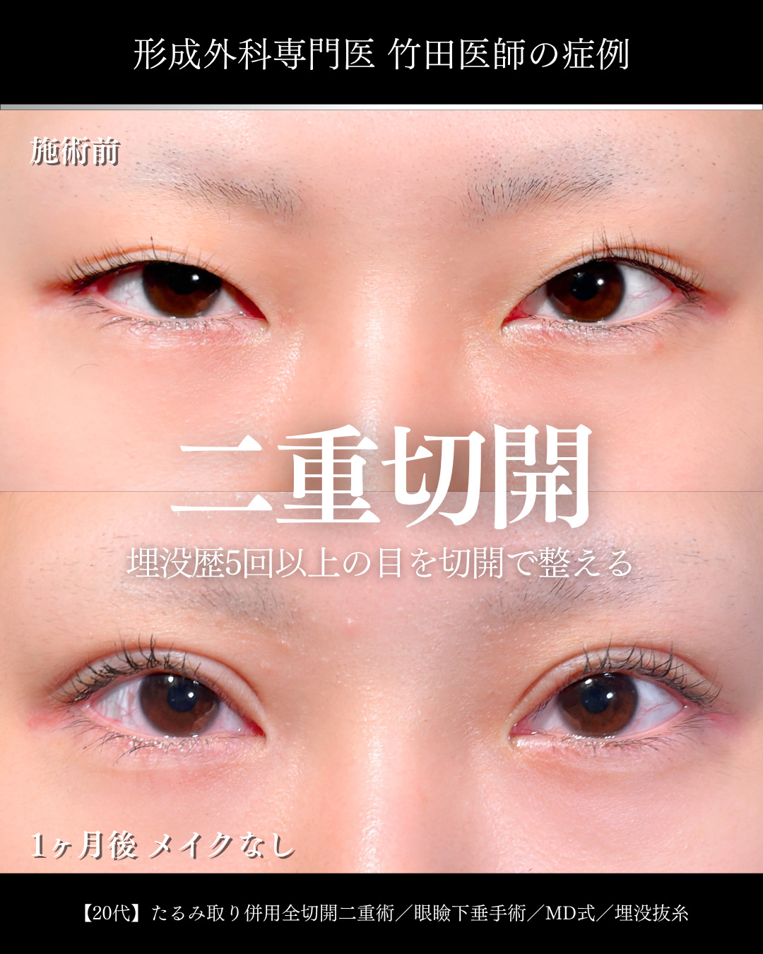 大宮院で行った二重整形で有名な竹田昌平医師の全切開二重術と眼瞼下垂手術の症例写真