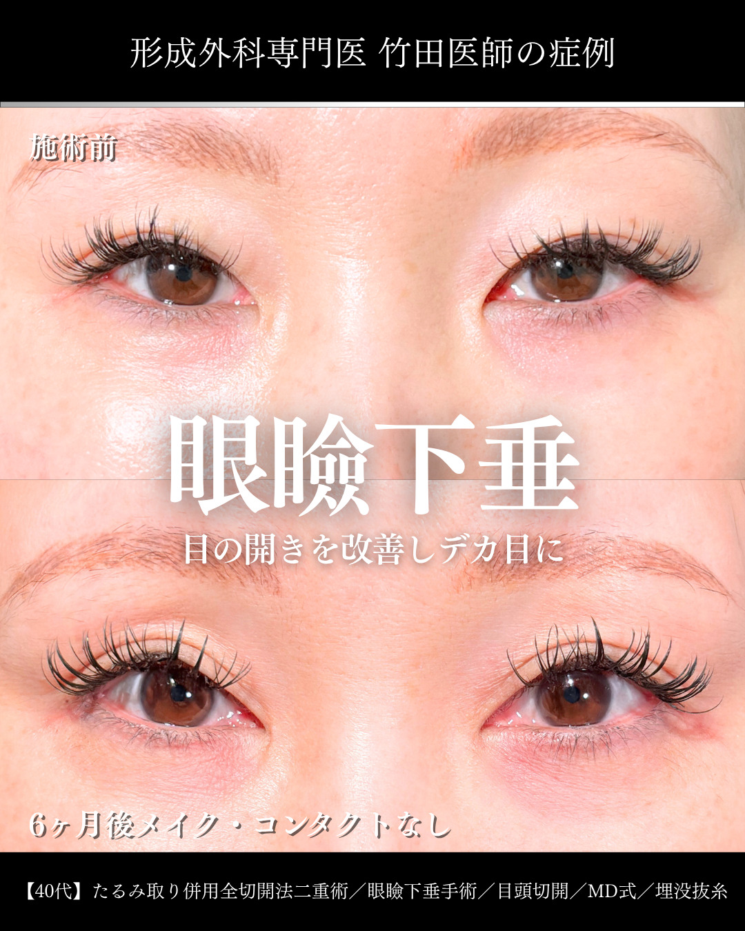 大宮院で行った二重整形で有名な竹田昌平医師の全切開二重術と眼瞼下垂手術と目頭切開の症例写真