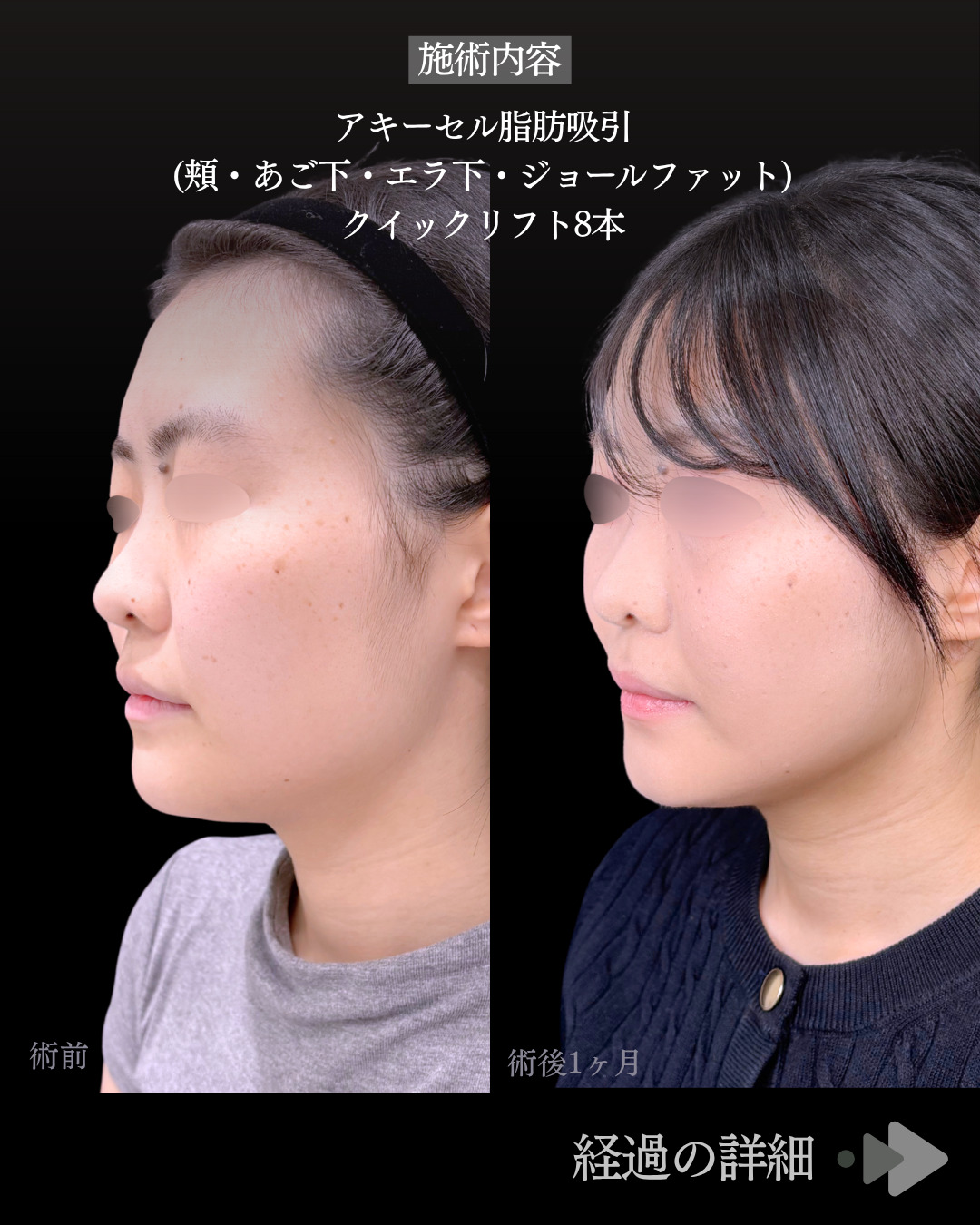 池袋院で行ったアキーセル小顔脂肪吸引(頬・あご下・エラ下・ジョールファット) と糸リフト8本整形の名医の症例写真