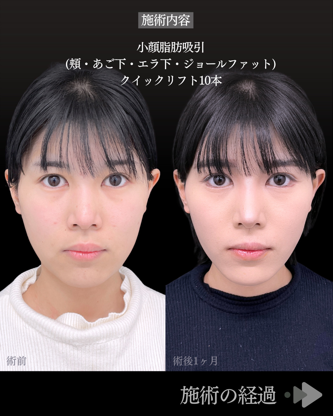 池袋院で行った小顔脂肪吸引(頬・あご下・エラ下・ジョールファット) とクイックリフト10本整形の名医の症例写真