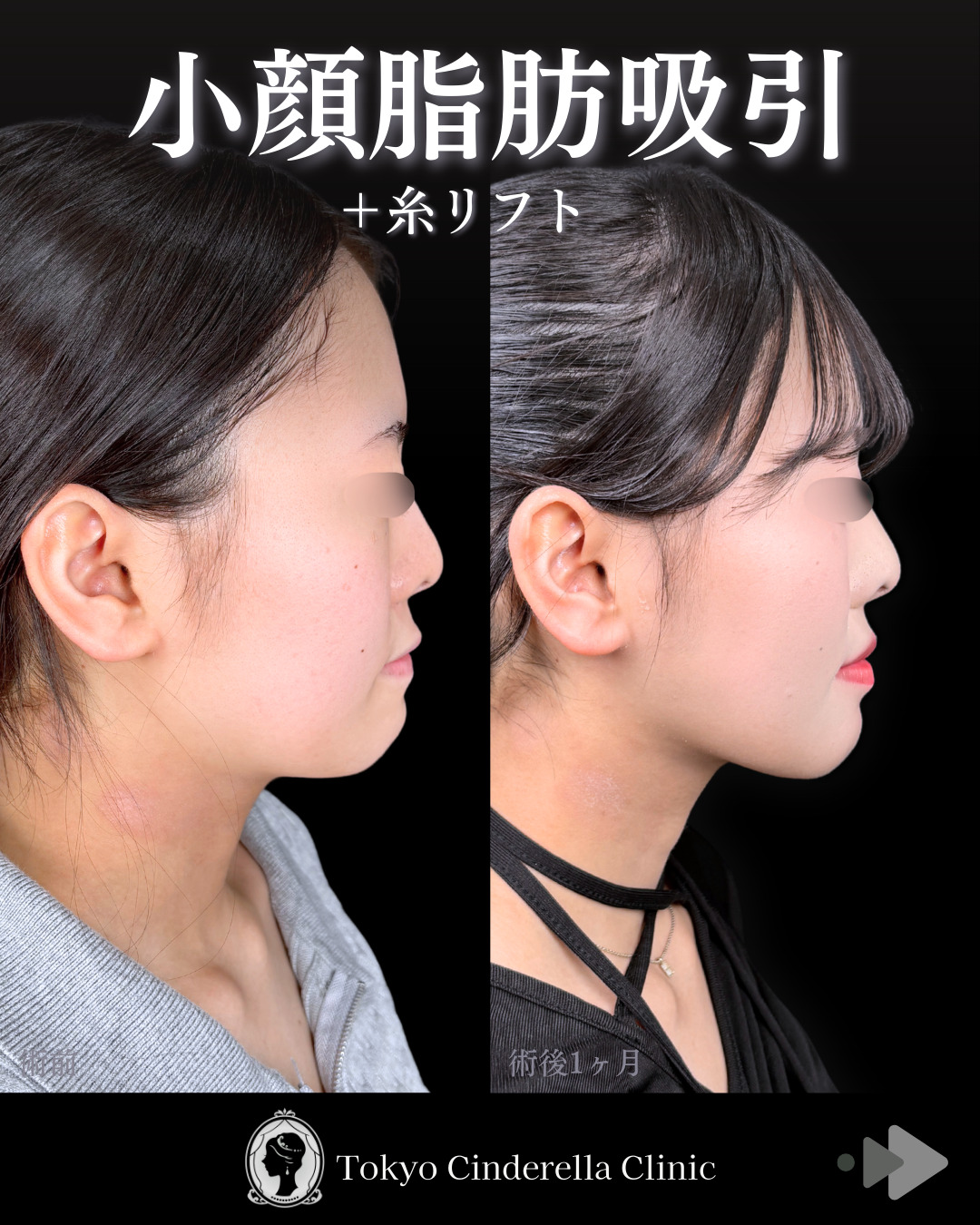 自然で美しいフェイスラインに