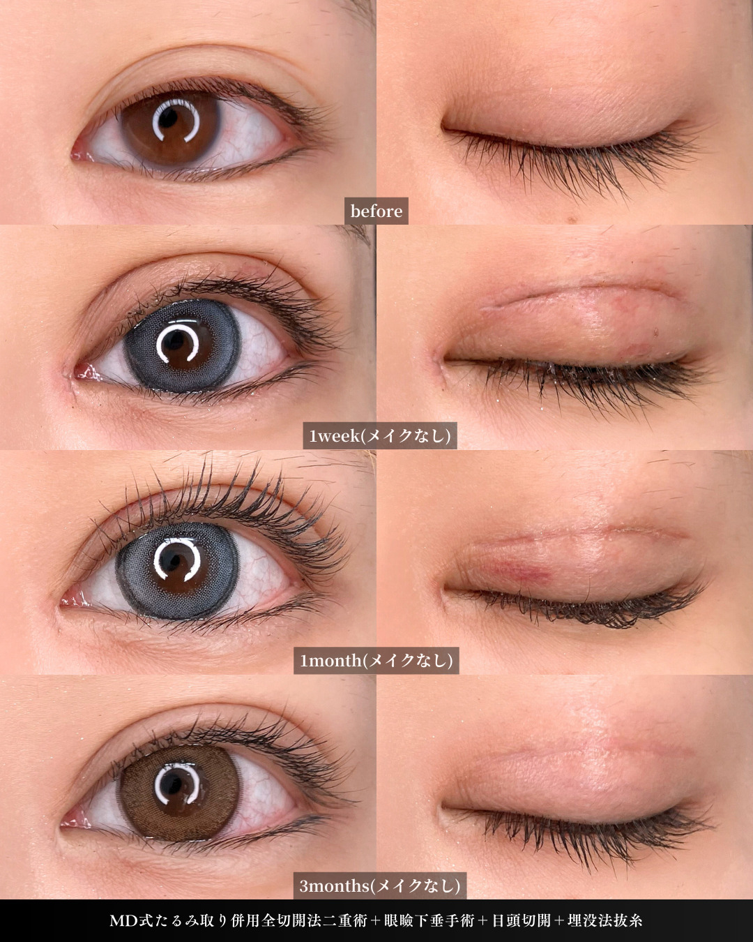 目の開きが悪く眼瞼下垂だった方の切開の３ヶ月ダウンタイム症例