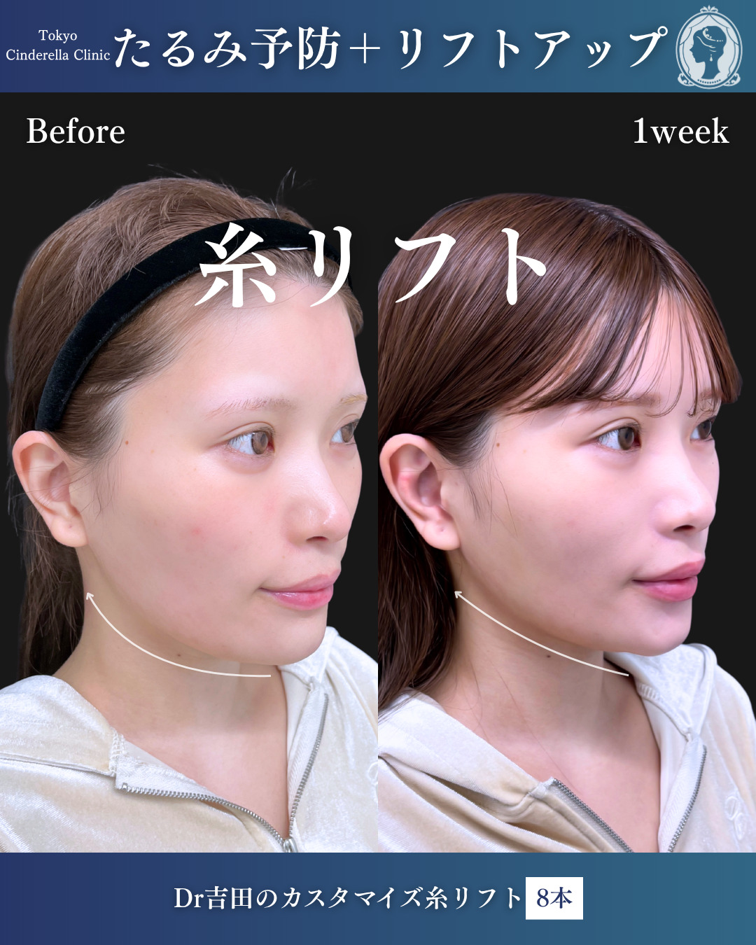 新宿院で行った糸リフトの名医の吉田利之医師の症例写真