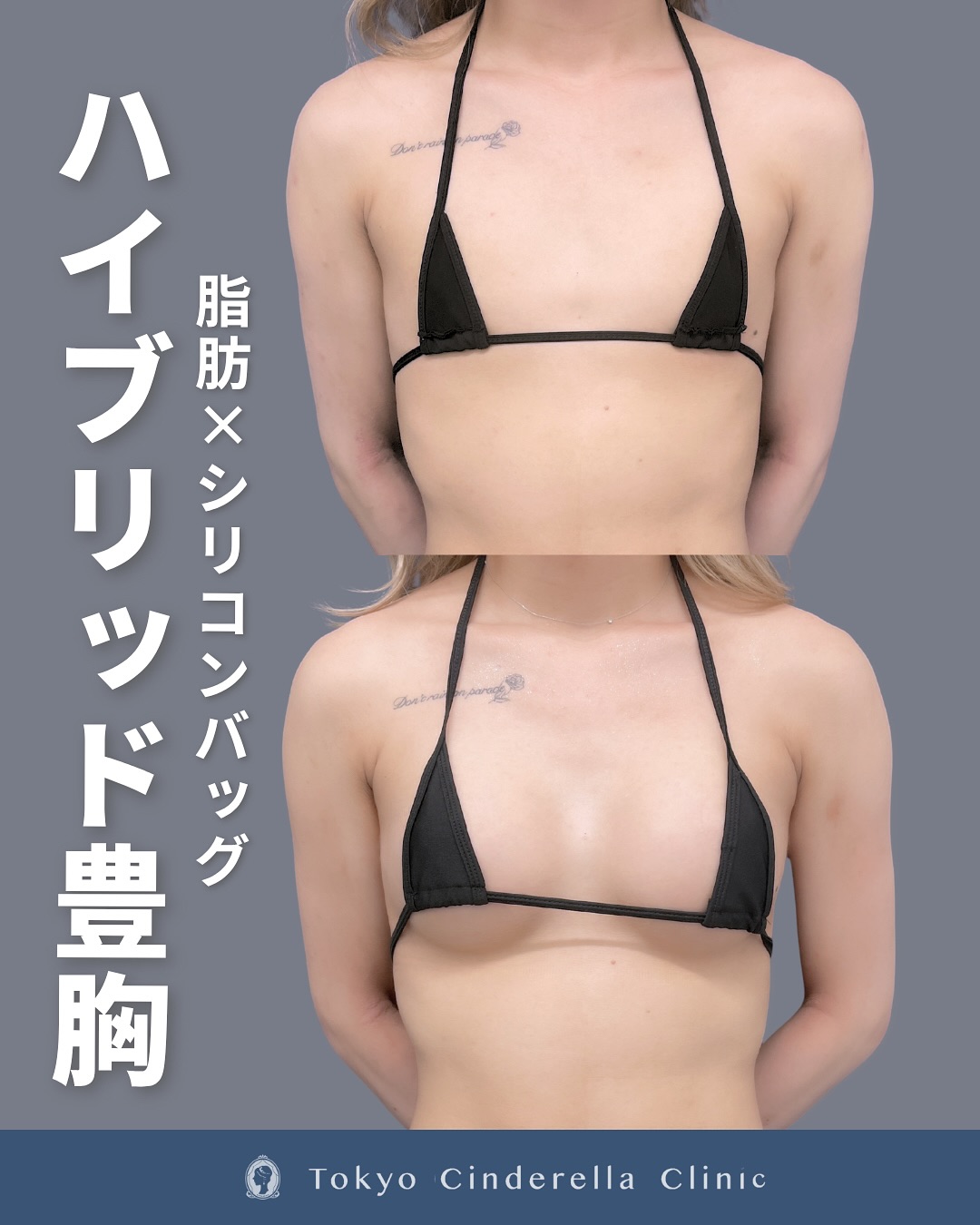 新宿院で行ったシリコンバッグ豊胸、アキーセル脂肪注入のハイブリッド豊胸の３ヵ月後の症例写真