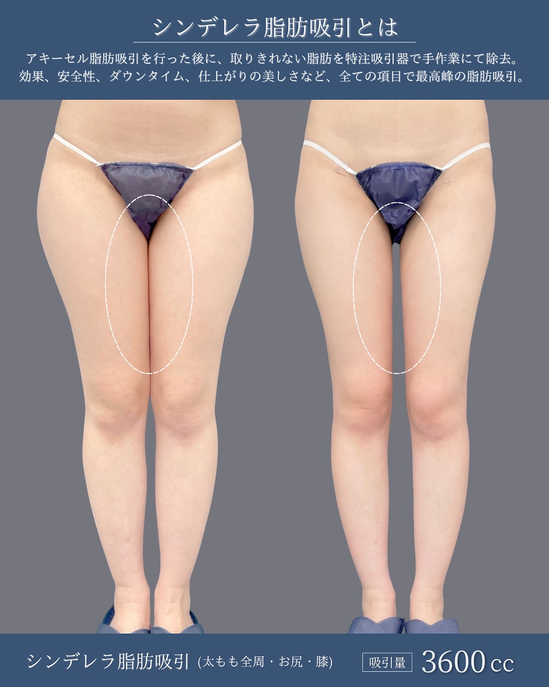 新宿院で行った太ももとお尻と膝のシンデレラ脂肪吸引の1ヶ月後のダウンタイム症例