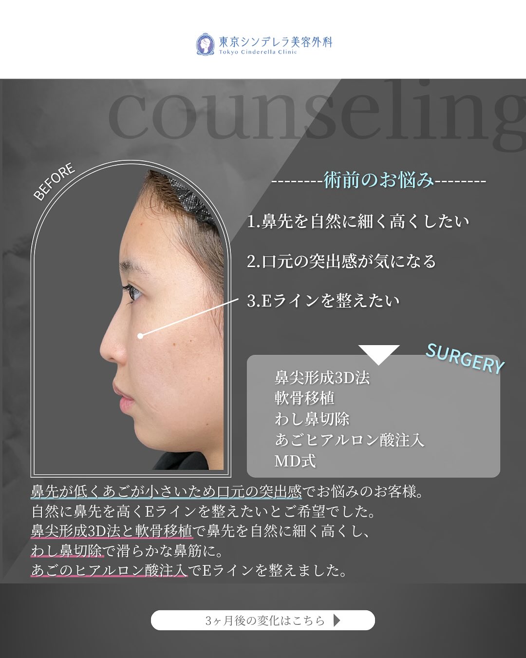 新宿院で行った鼻尖形成3D法と軟骨移植とわし鼻切除とあごのヒアルロン酸注入の3ヵ月後の症例写真