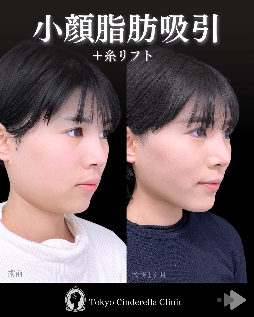 池袋院で行った小顔脂肪吸引(頬・あご下・エラ下・ジョールファット) とクイックリフト10本整形の名医の症例写真