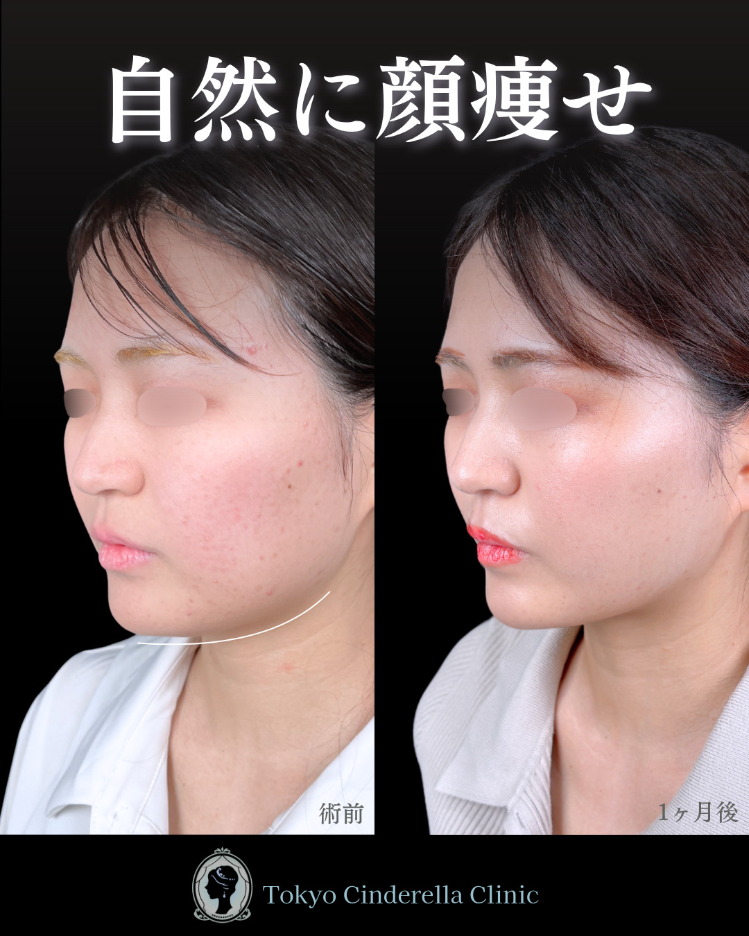 池袋院で行った小顔整形の名医の症例写真