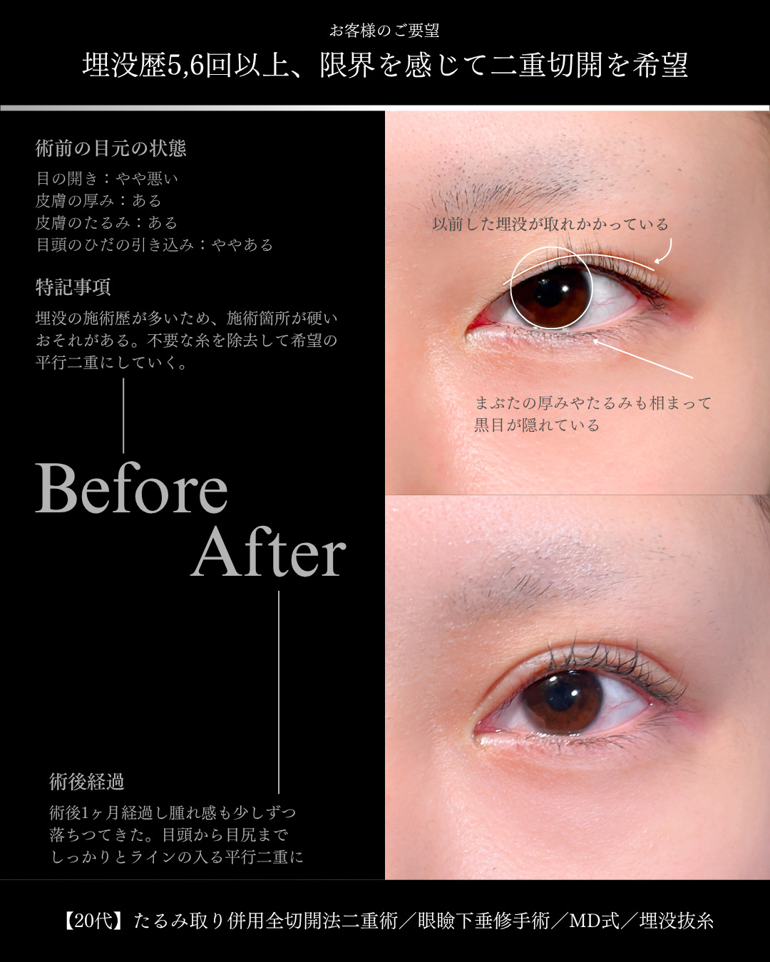 大宮院で行った二重整形で有名な竹田昌平医師の全切開二重術と眼瞼下垂手術の症例写真