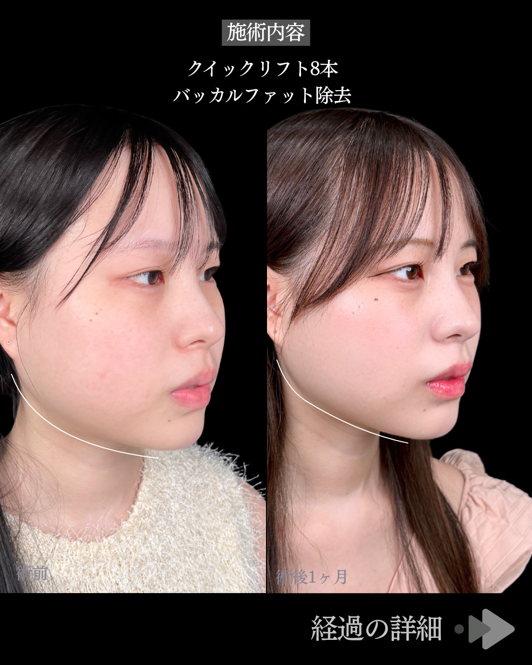池袋院で行った糸リフト8本とバッカルファット除去整形で有名な名医の石井達也の症例写真