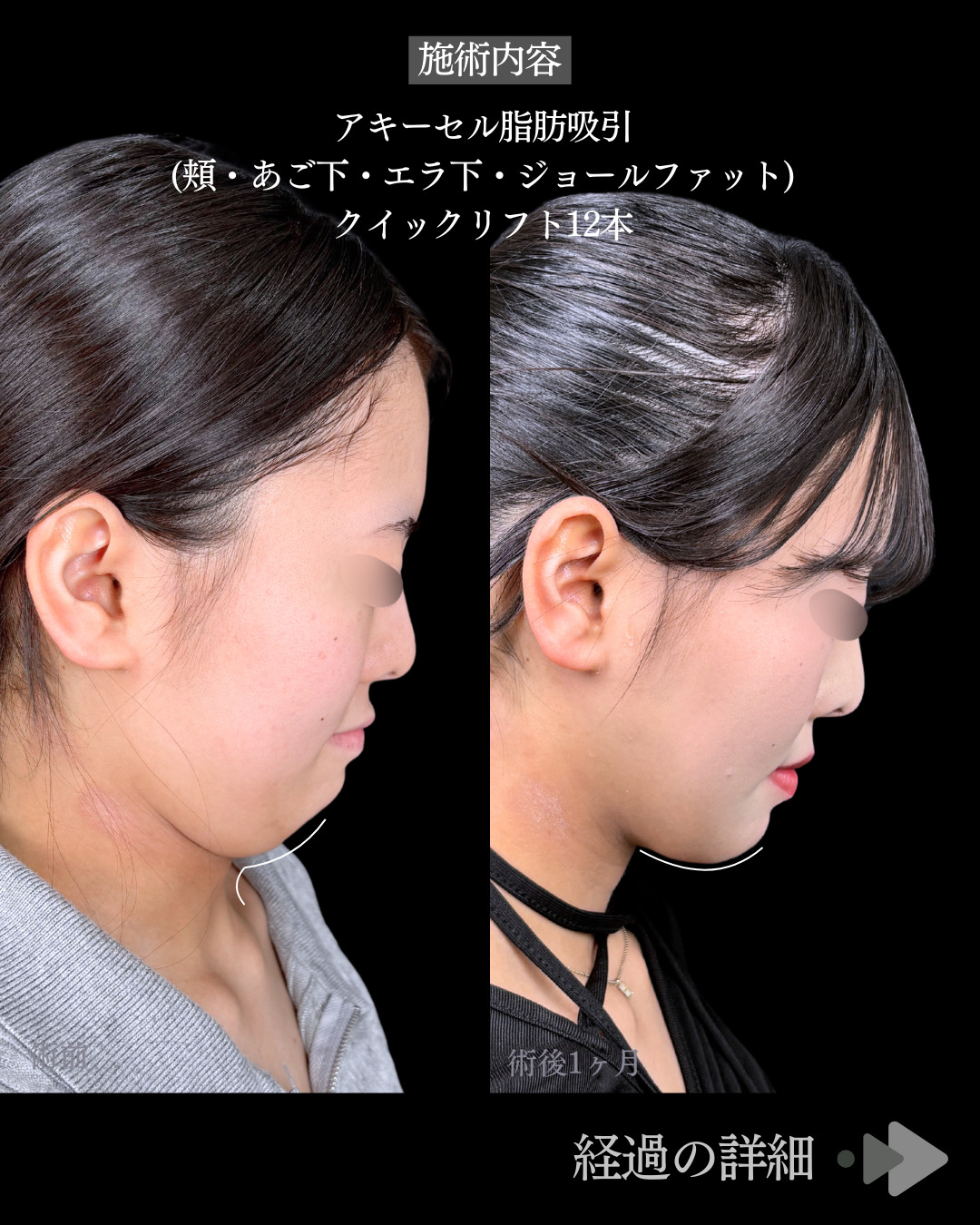 池袋院で行ったアキーセル脂肪吸引(頬・あご下・エラ下・ジョールファット)と糸リフト12本整形で有名な名医の石井達也の症例写真