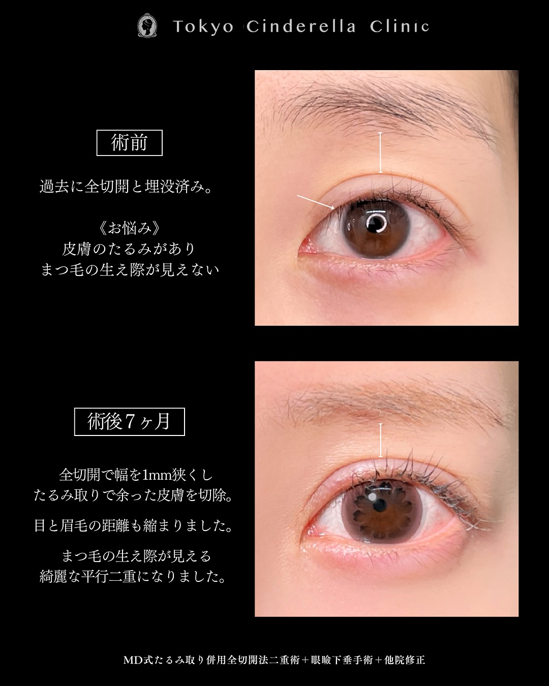 新宿院で二重切開と眼瞼下垂を行った7ヶ月後のダウンタイム症例
