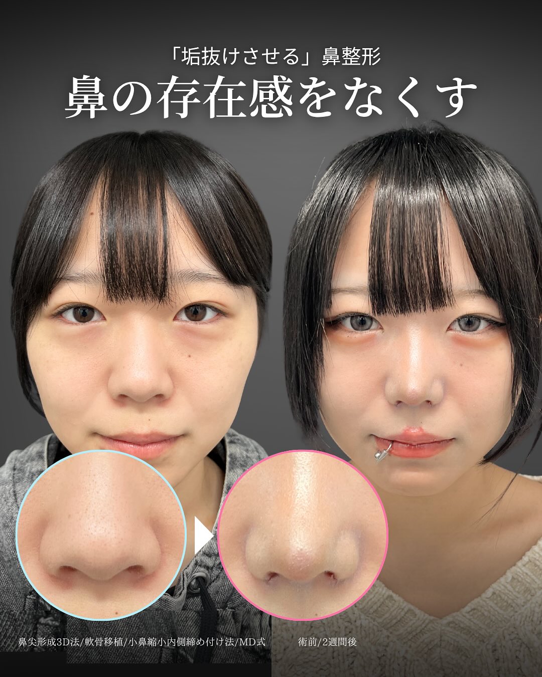 新宿院で行った鼻整形で有名な吉原伯医師のMD式の鼻尖形成3D法と軟骨移植と小鼻縮小内側締め付け法の2週間後の症例写真