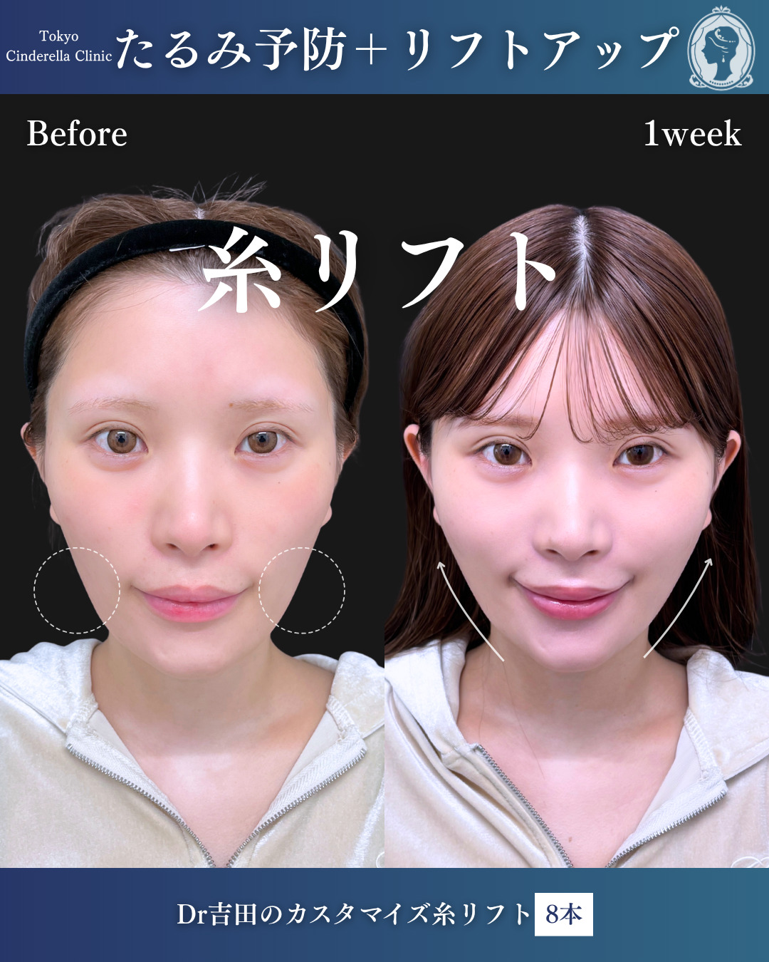 新宿院で行った糸リフトの名医の吉田利之医師の症例写真