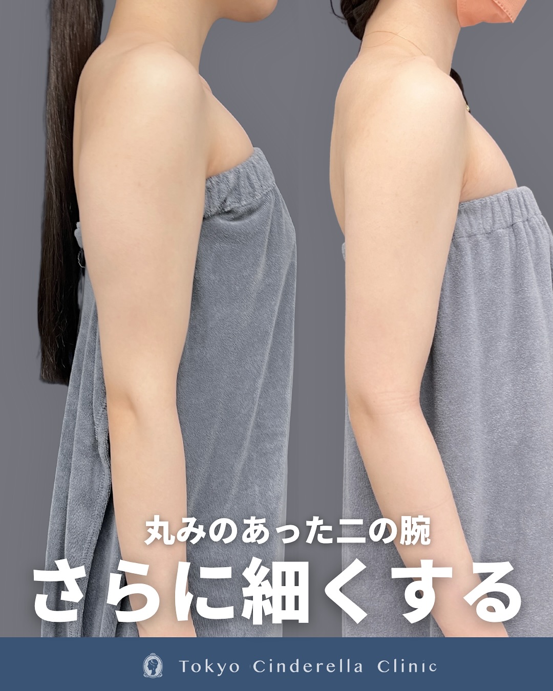 新宿院で行った二の腕のアキーセル脂肪吸引とボトックス注射併用の1ヶ月後までの症例写真