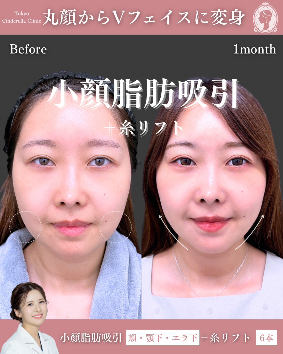 新宿院で行った脂肪吸引の名医の梅田絢乃医師の症例写真