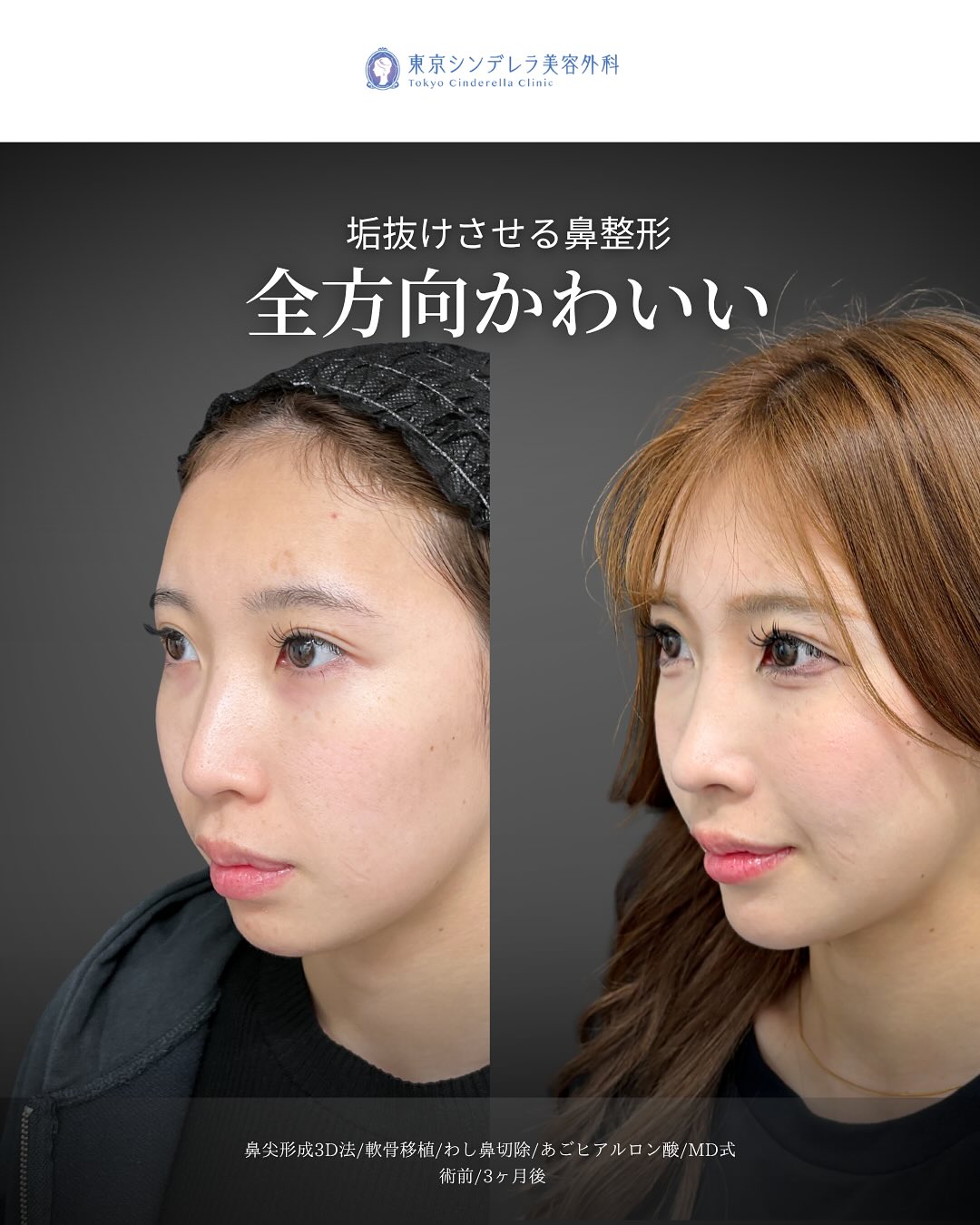 新宿院で行った鼻尖形成3D法と軟骨移植とわし鼻切除とあごのヒアルロン酸注入の3ヵ月後の症例写真