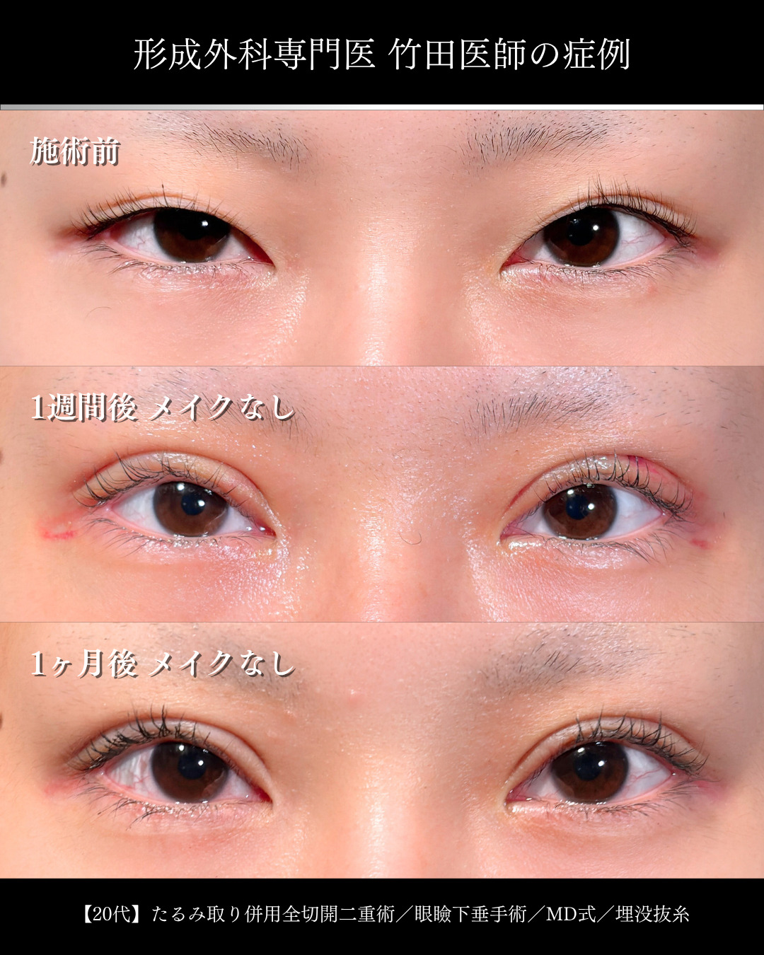 大宮院で行った二重整形で有名な竹田昌平医師の全切開二重術と眼瞼下垂手術の症例写真