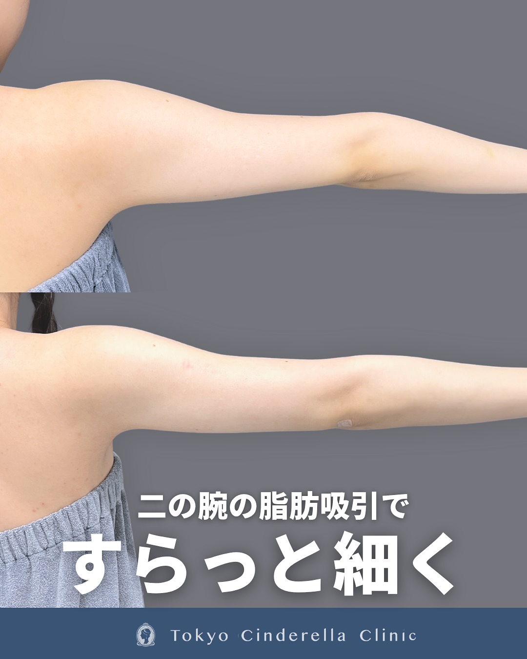 新宿院で行った二の腕のアキーセル脂肪吸引とボトックス注射併用の1ヶ月後の症例写真