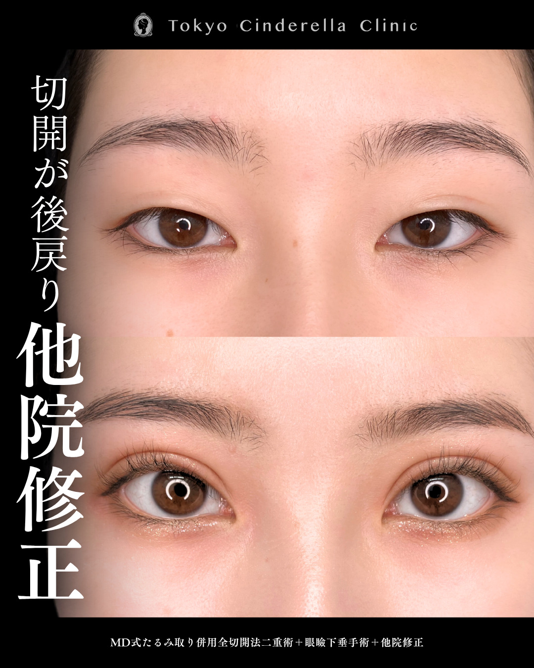 他院修正で二重切開と眼瞼下垂を行った６ヶ月までのダウンタイム症例