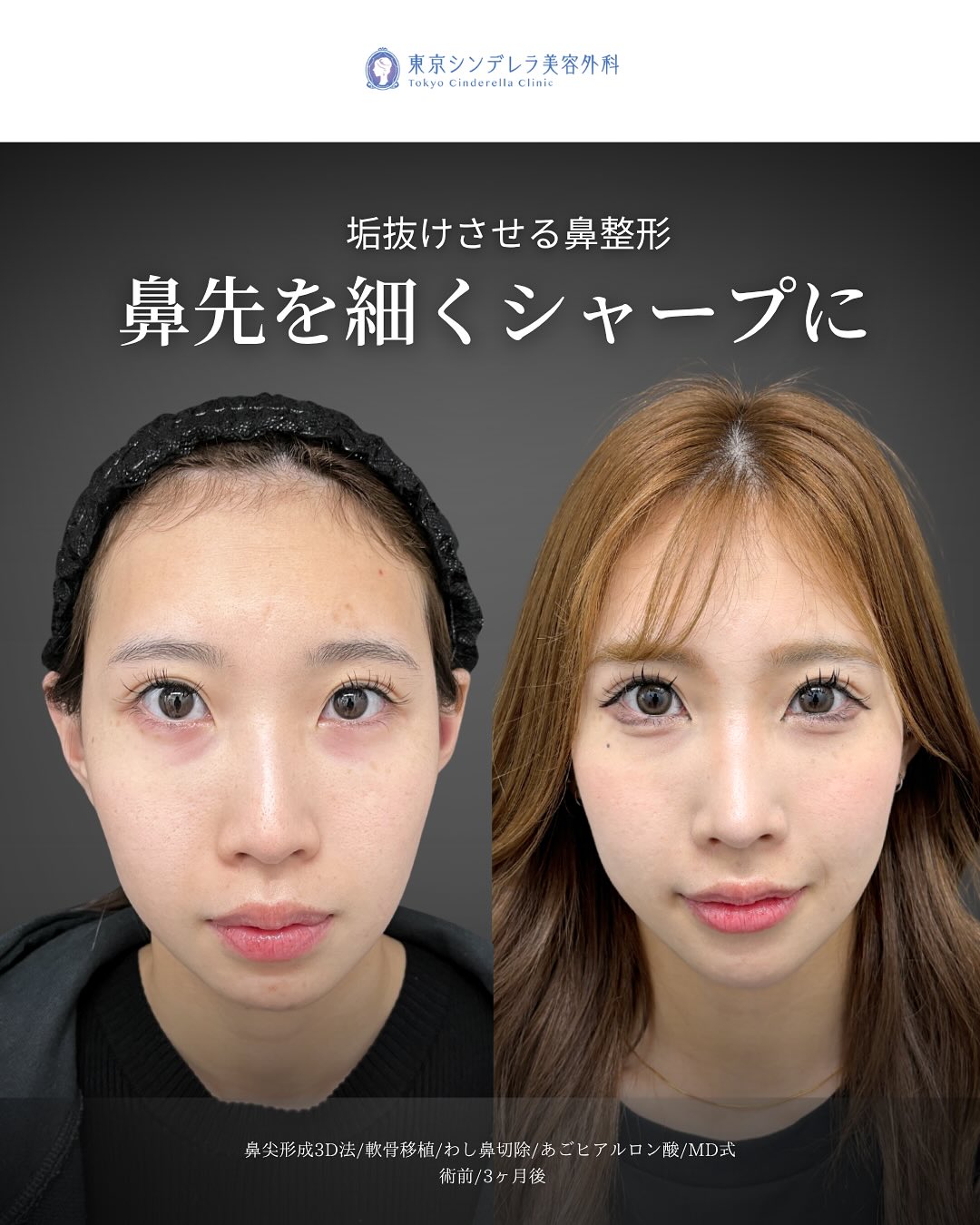 新宿院で行った鼻尖形成3D法と軟骨移植とわし鼻切除とあごのヒアルロン酸注入の3ヵ月後の症例写真