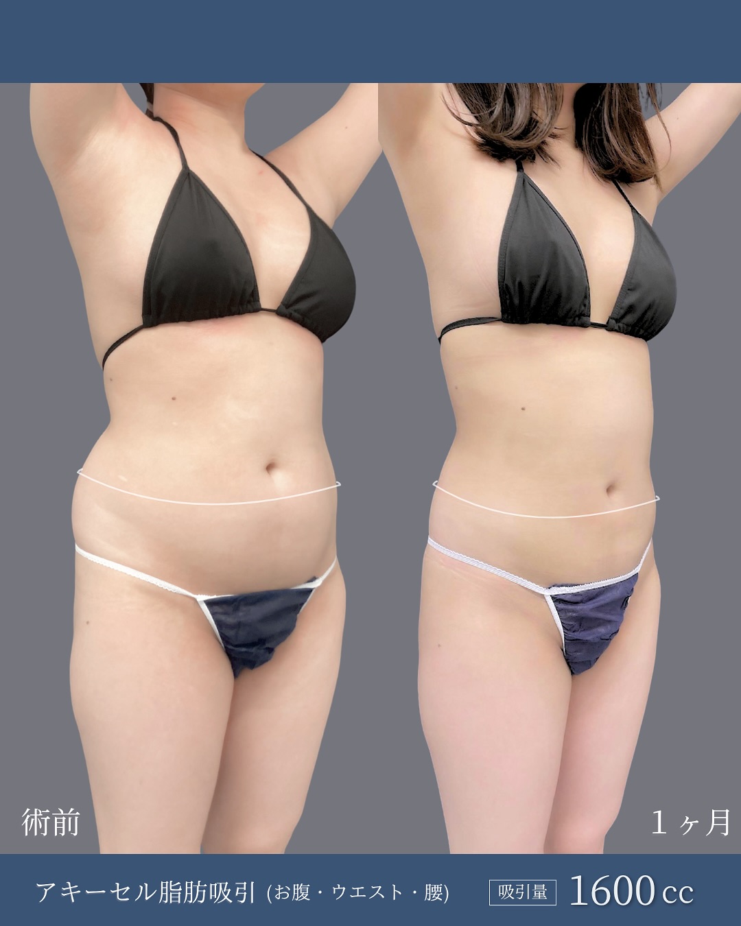 新宿院で行ったお腹とウエストと腰のアキーセル脂肪吸引の症例写真