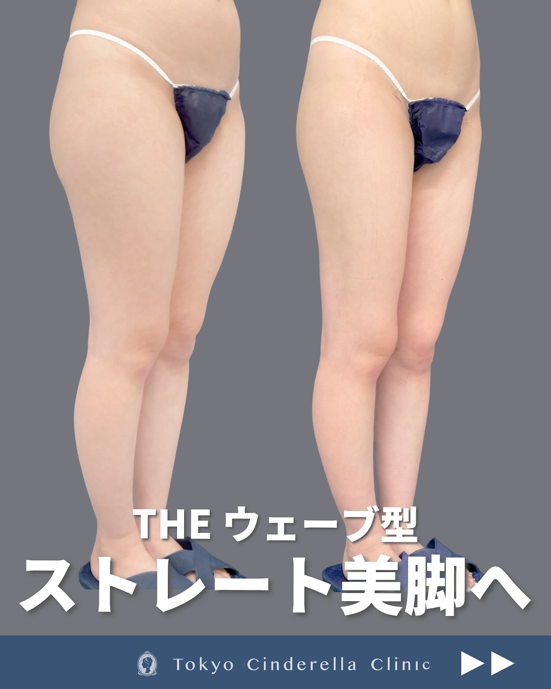 新宿院で行った太ももとお尻と膝のシンデレラ脂肪吸引の1ヶ月後のダウンタイム症例