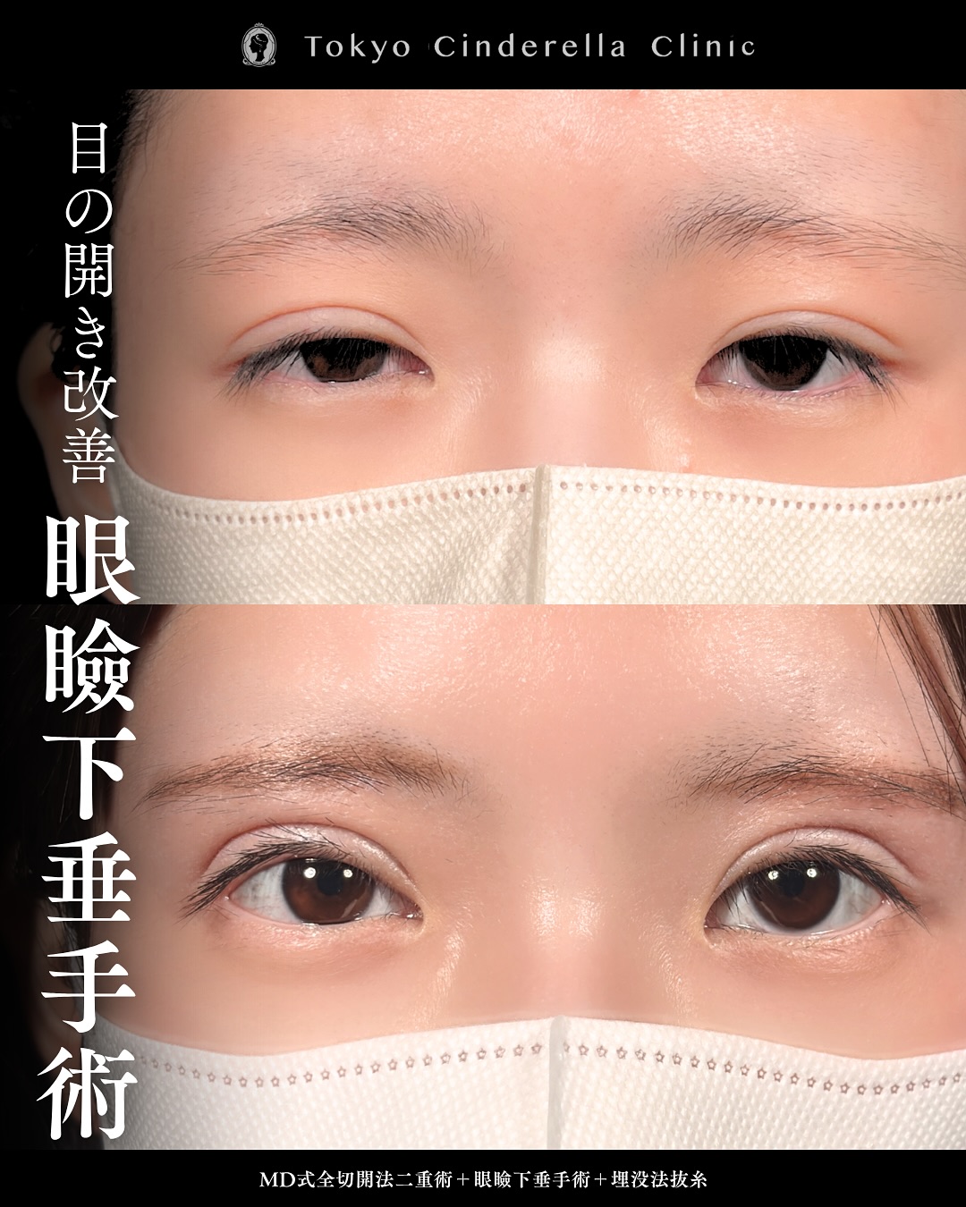 新宿院で行った二重整形で有名な吉原伯医師のMD式の全切開法二重術と眼瞼下垂手術の3ヵ月後の症例写真