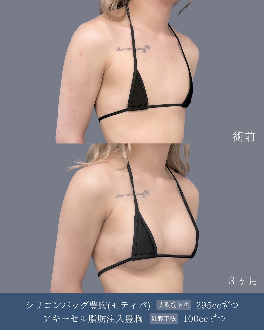 新宿院で行ったシリコンバッグ豊胸、アキーセル脂肪注入のハイブリッド豊胸の３ヵ月後の症例写真