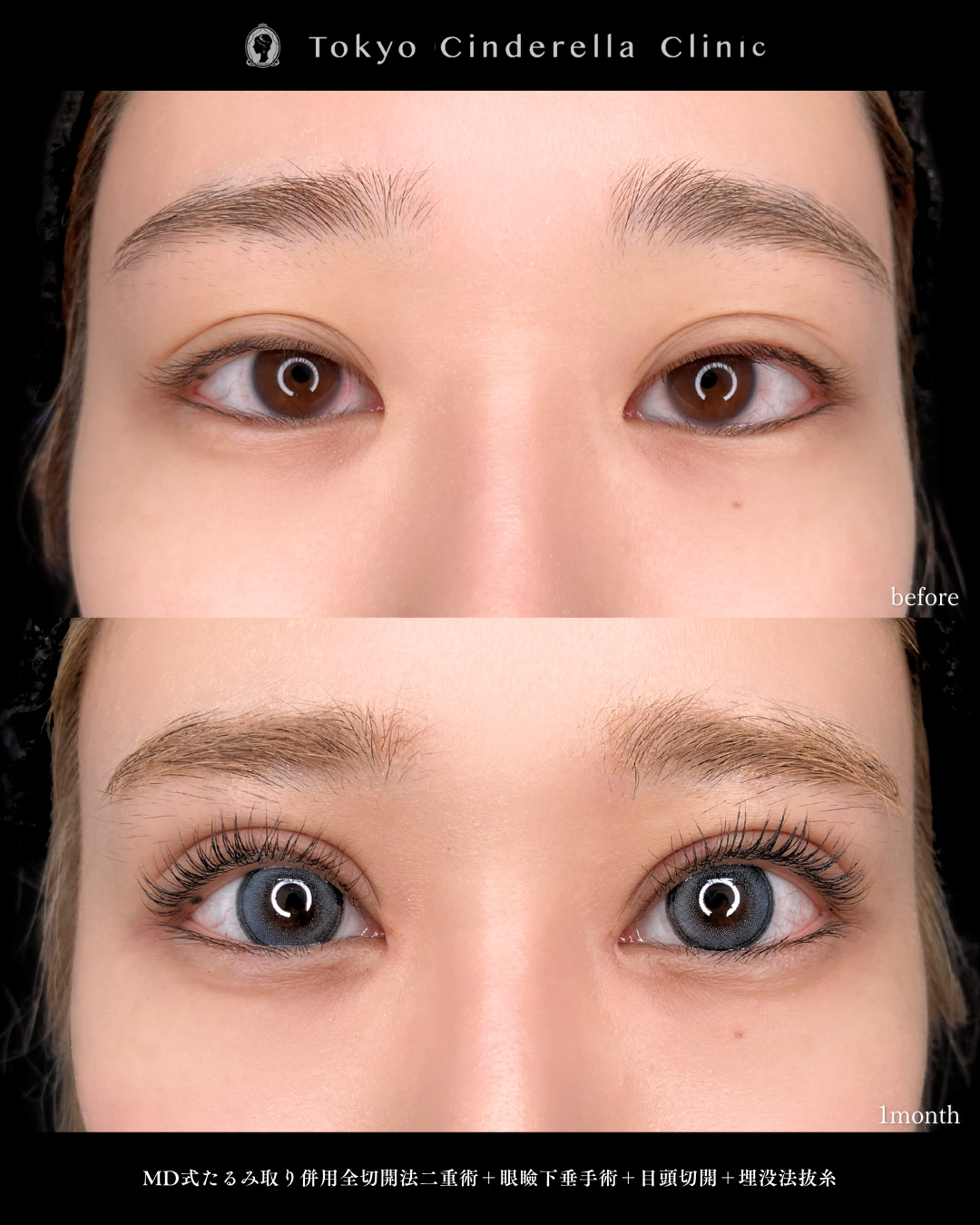 目の開きが悪く眼瞼下垂だった方の切開の３ヶ月ダウンタイム症例