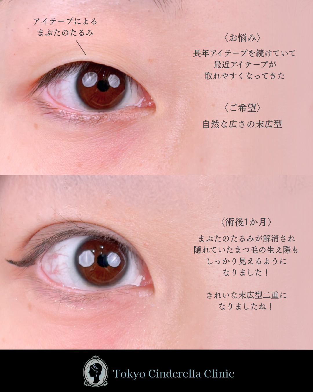 池袋院で行った二重整形で有名な名医の石井達也の症例写真