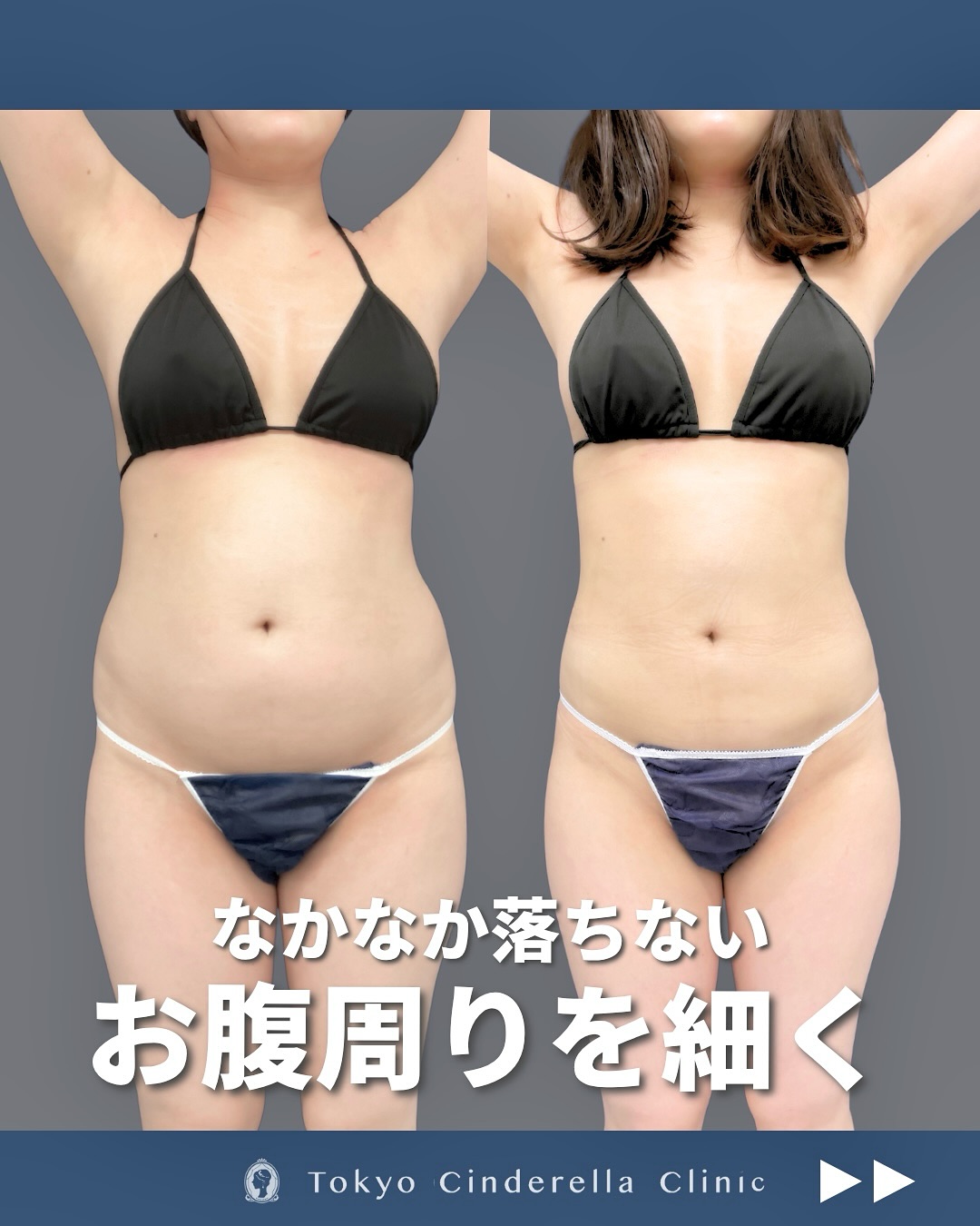 新宿院で行ったお腹とウエストと腰のアキーセル脂肪吸引の症例写真