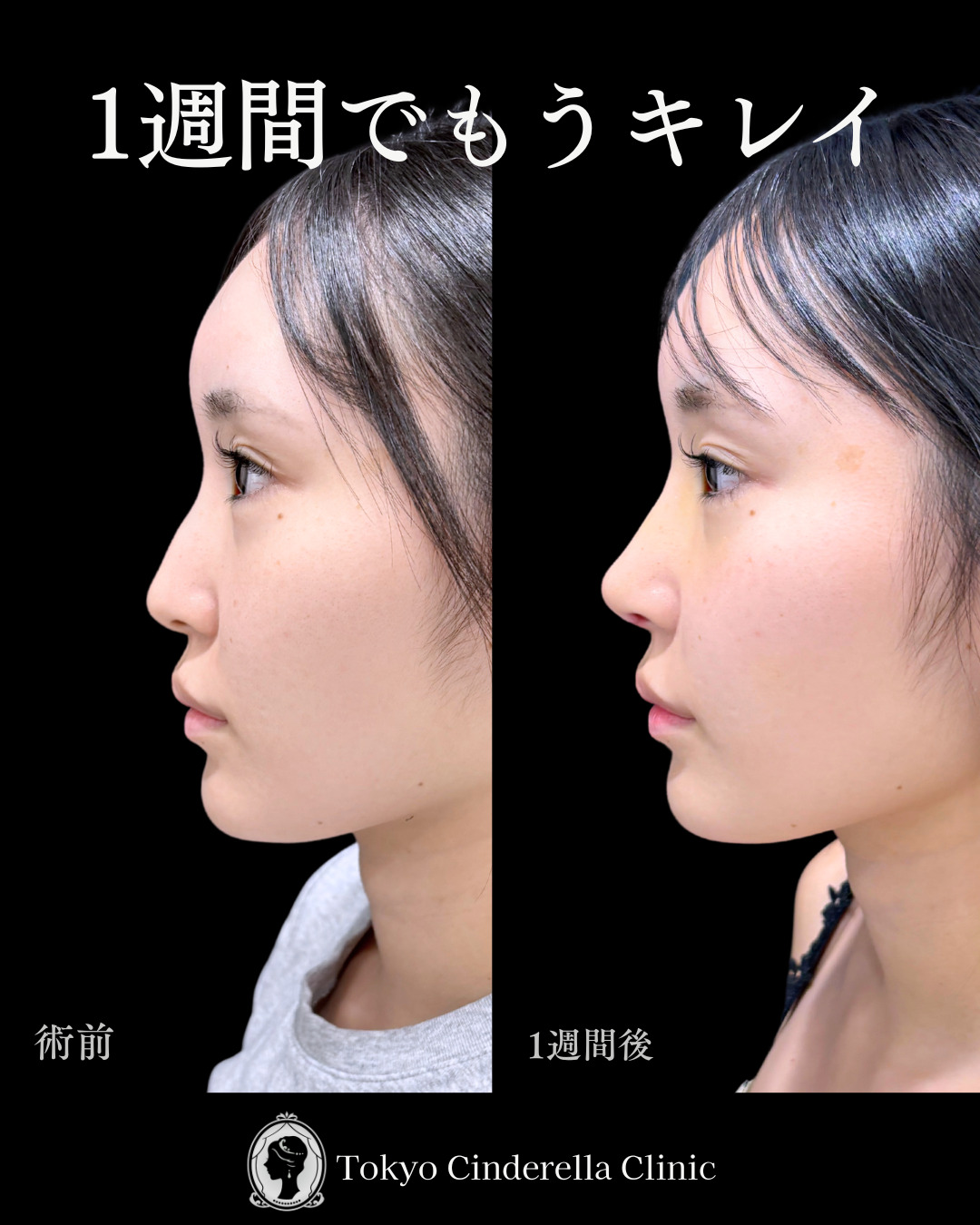 池袋院で行ったMD式の鼻尖形成3D法と軟骨移植とわし鼻削りとヒアルロン酸(貴族)整形の名医の症例写真