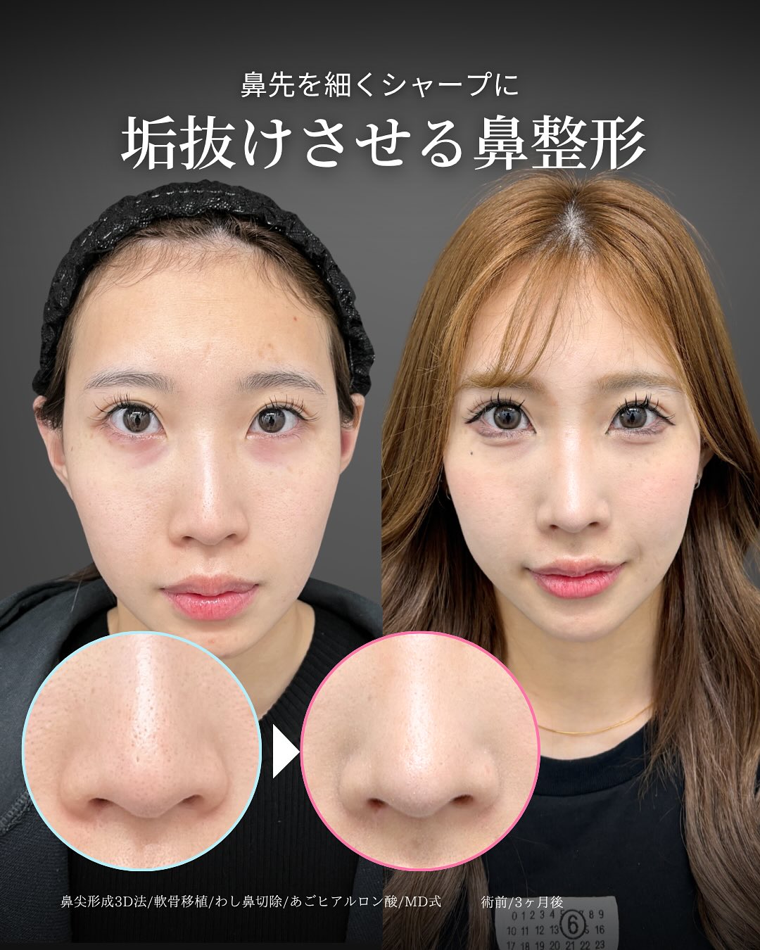 新宿院で行った鼻尖形成3D法と軟骨移植とわし鼻切除とあごのヒアルロン酸注入の3ヵ月後の症例写真