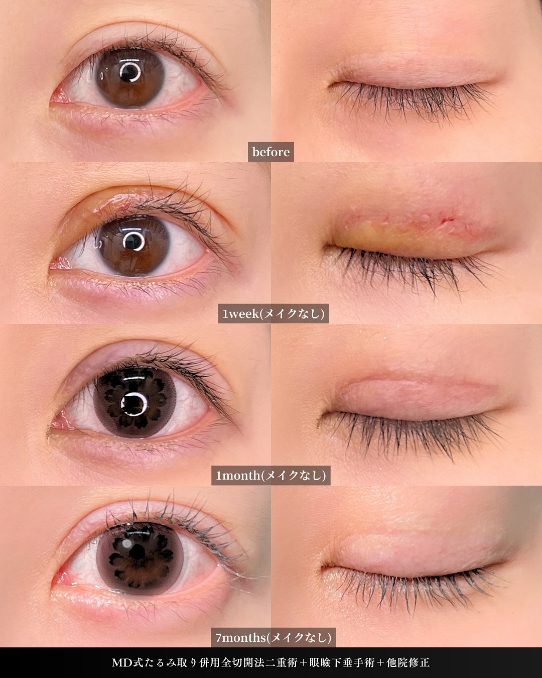 新宿院で二重切開と眼瞼下垂を行った7ヶ月後のダウンタイム症例