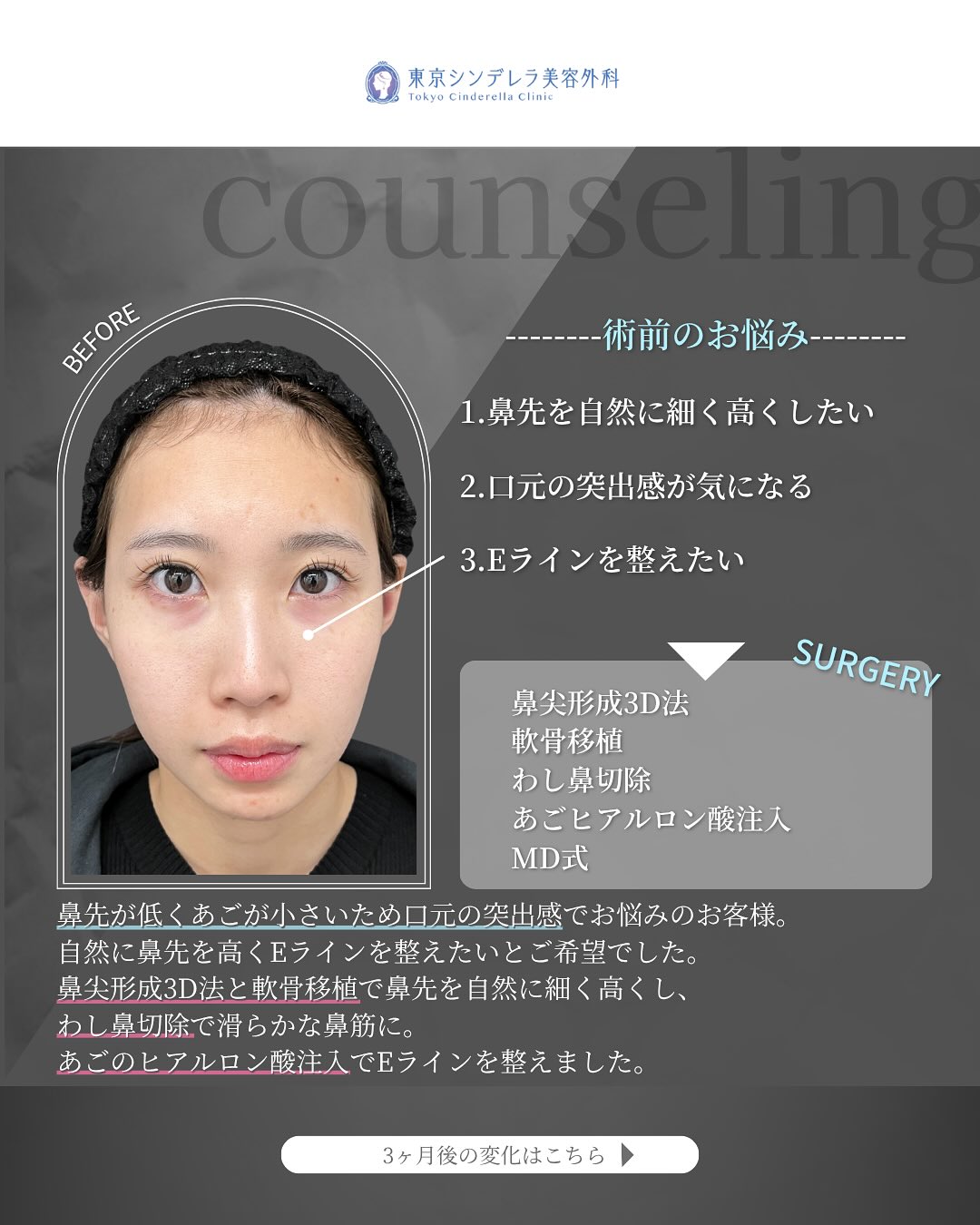 新宿院で行った鼻尖形成3D法と軟骨移植とわし鼻切除とあごのヒアルロン酸注入の3ヵ月後の症例写真